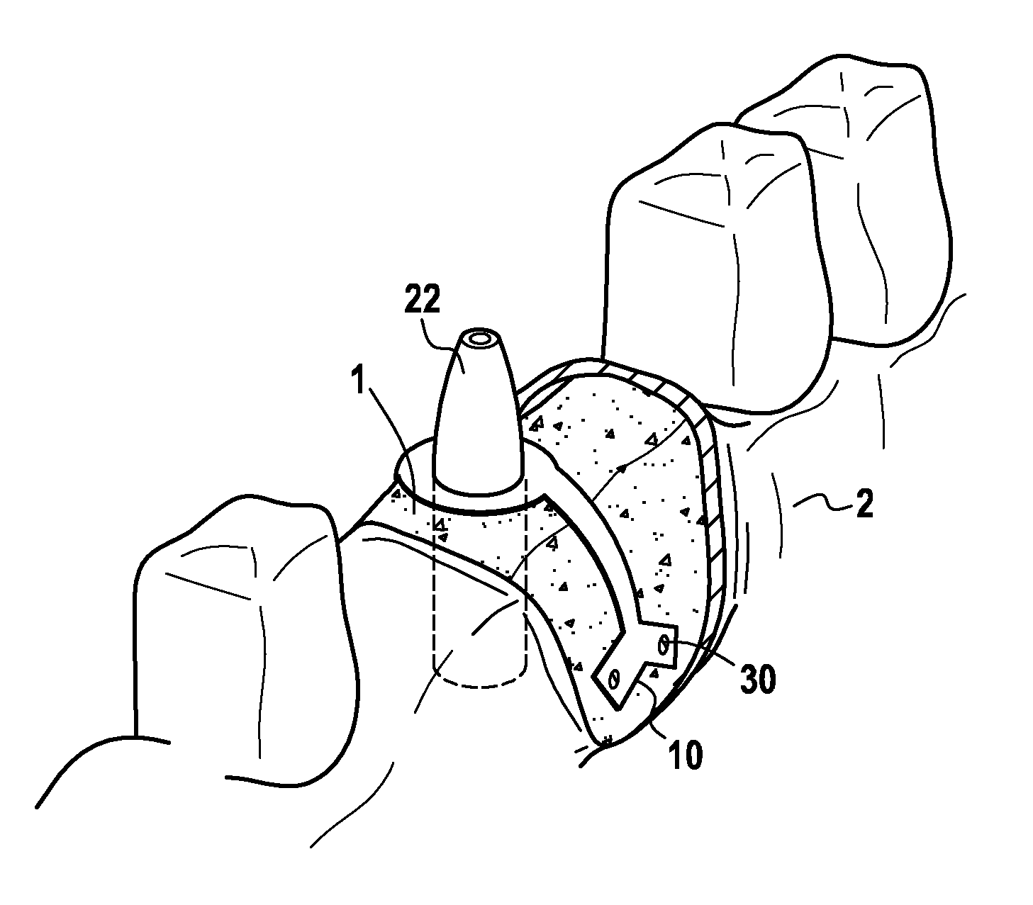 Additional stabilization device for endo-osseous dental implant