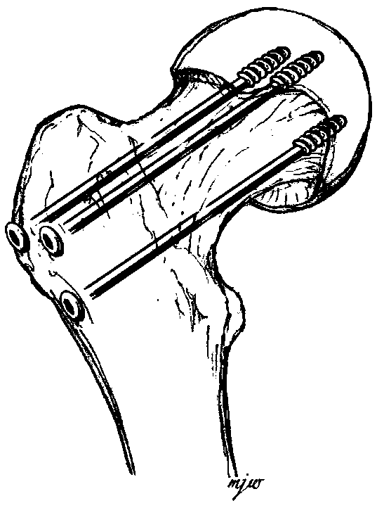 Femoral neck fracture fixing device