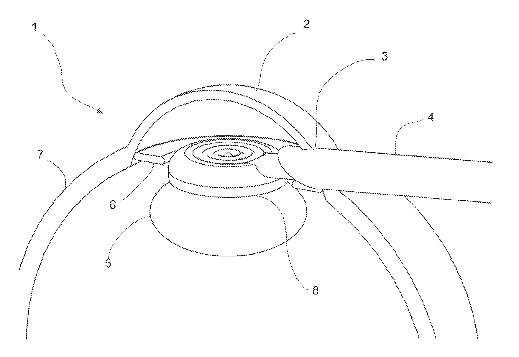 Ophthalmic surgical device for capsulotomy