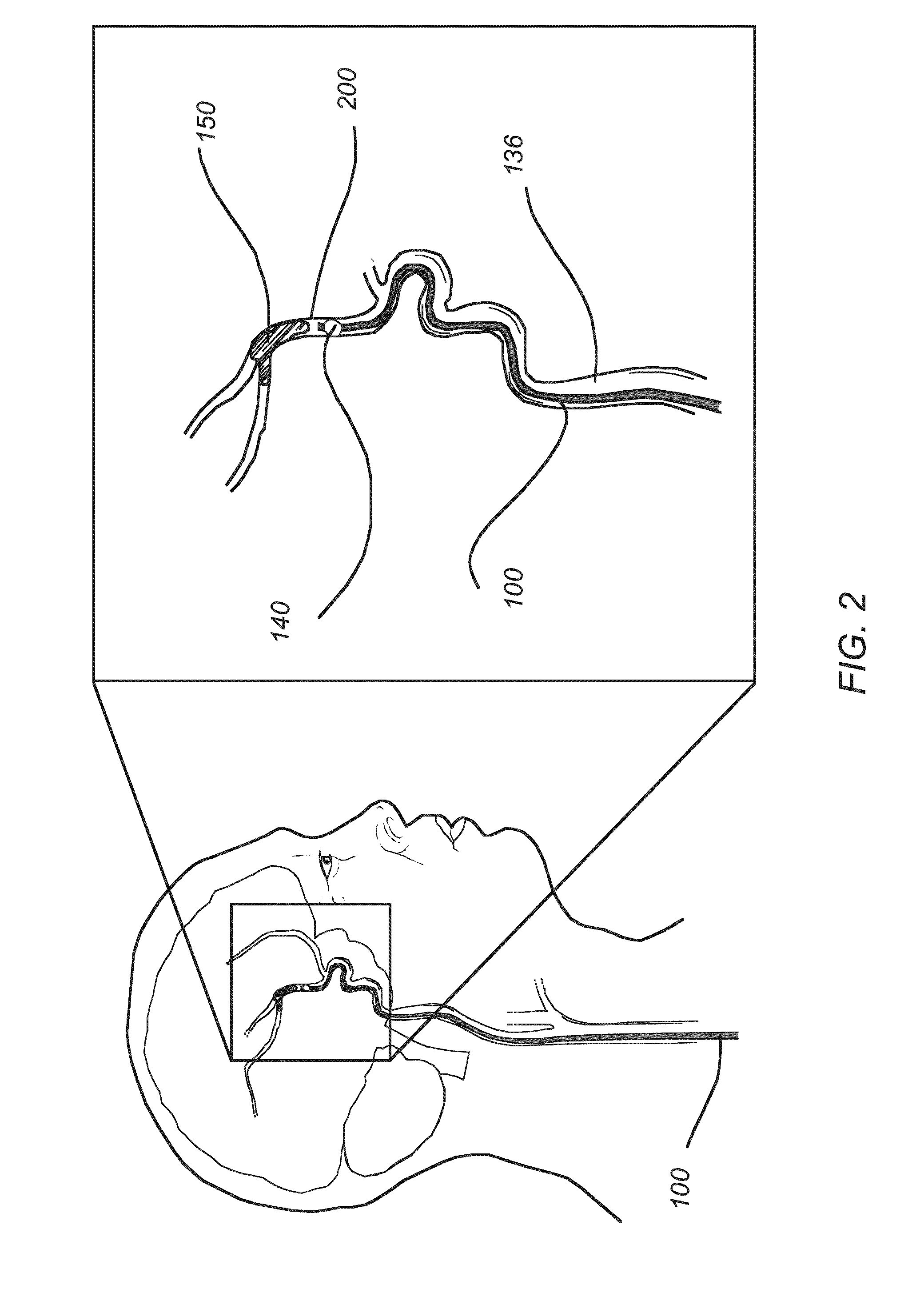 Post-conditioning suction catheter apparatus and methods
