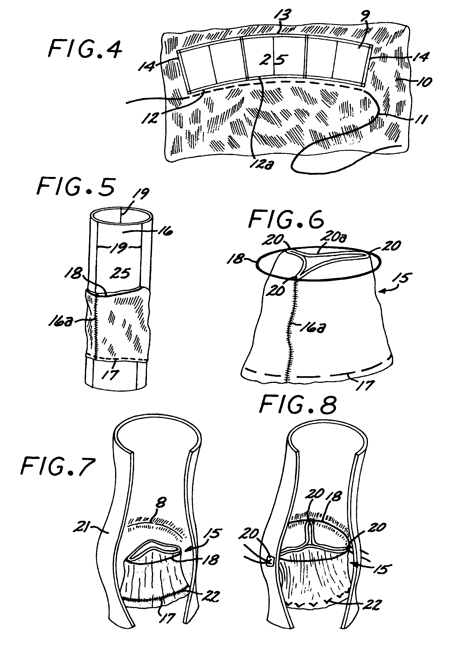 Sigmoid valve and method for its percutaneous implantation