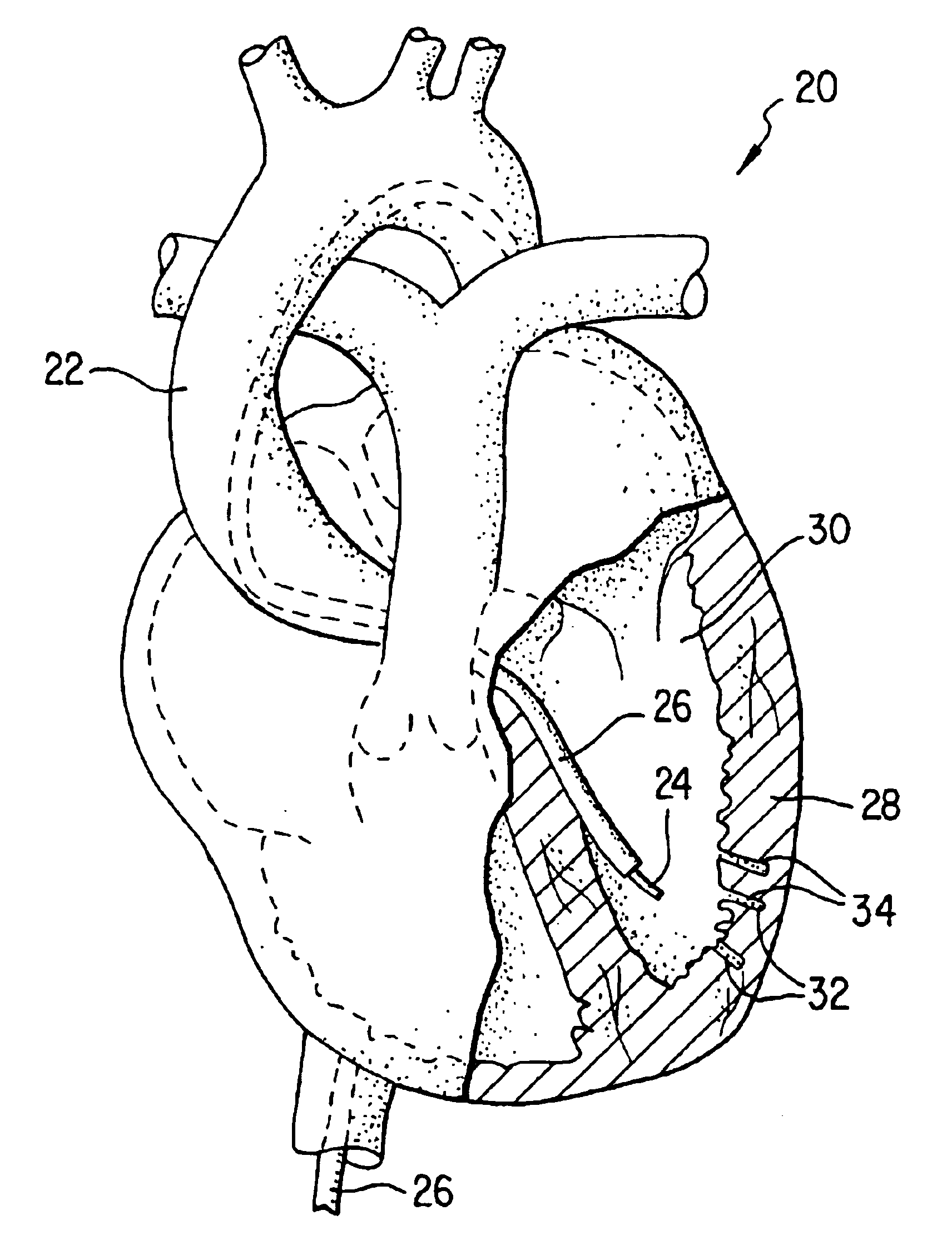 Methods for delivering a therapeutic implant to tissue