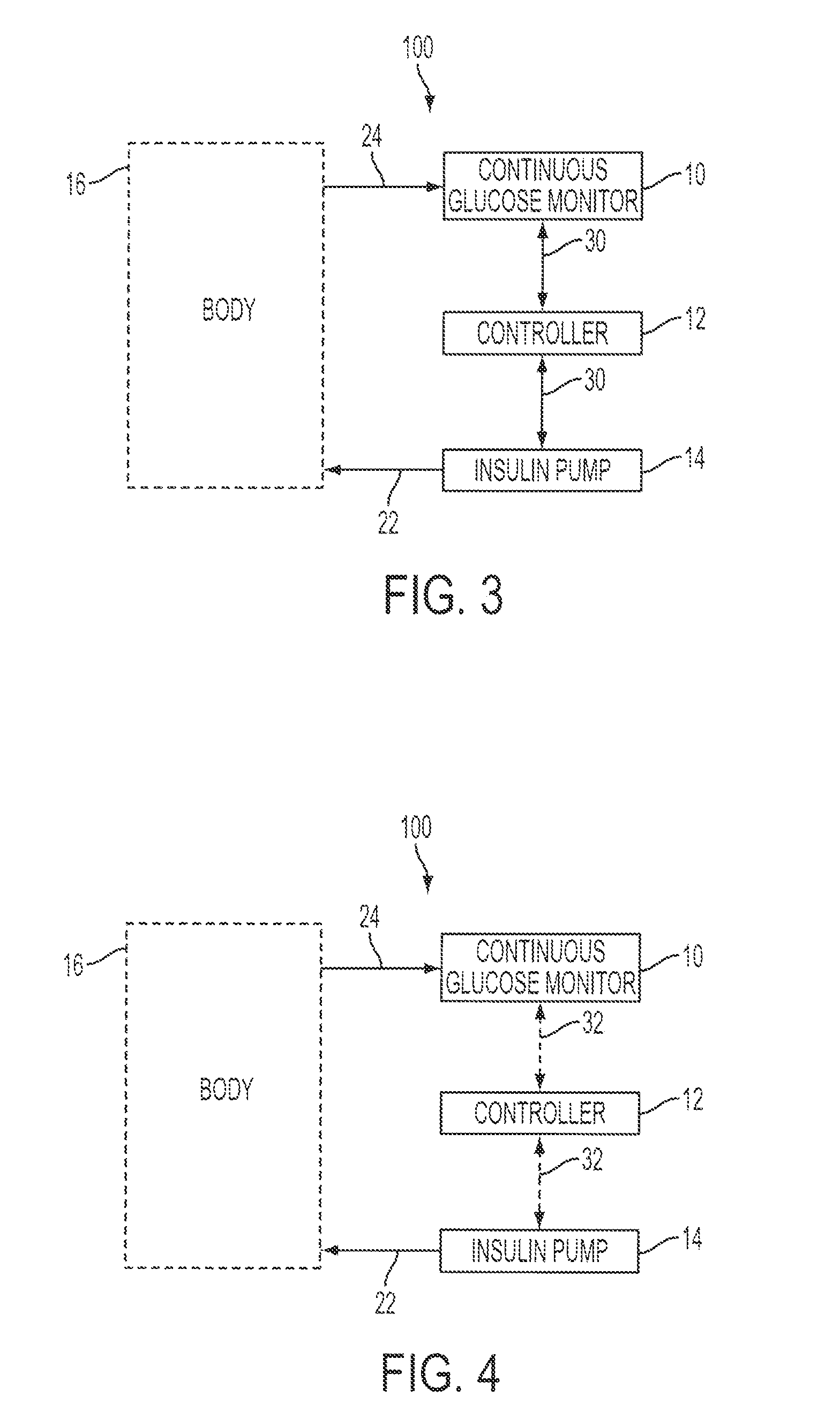 Predictive control based system and method for control of insulin delivery in diabetes using glucose sensing