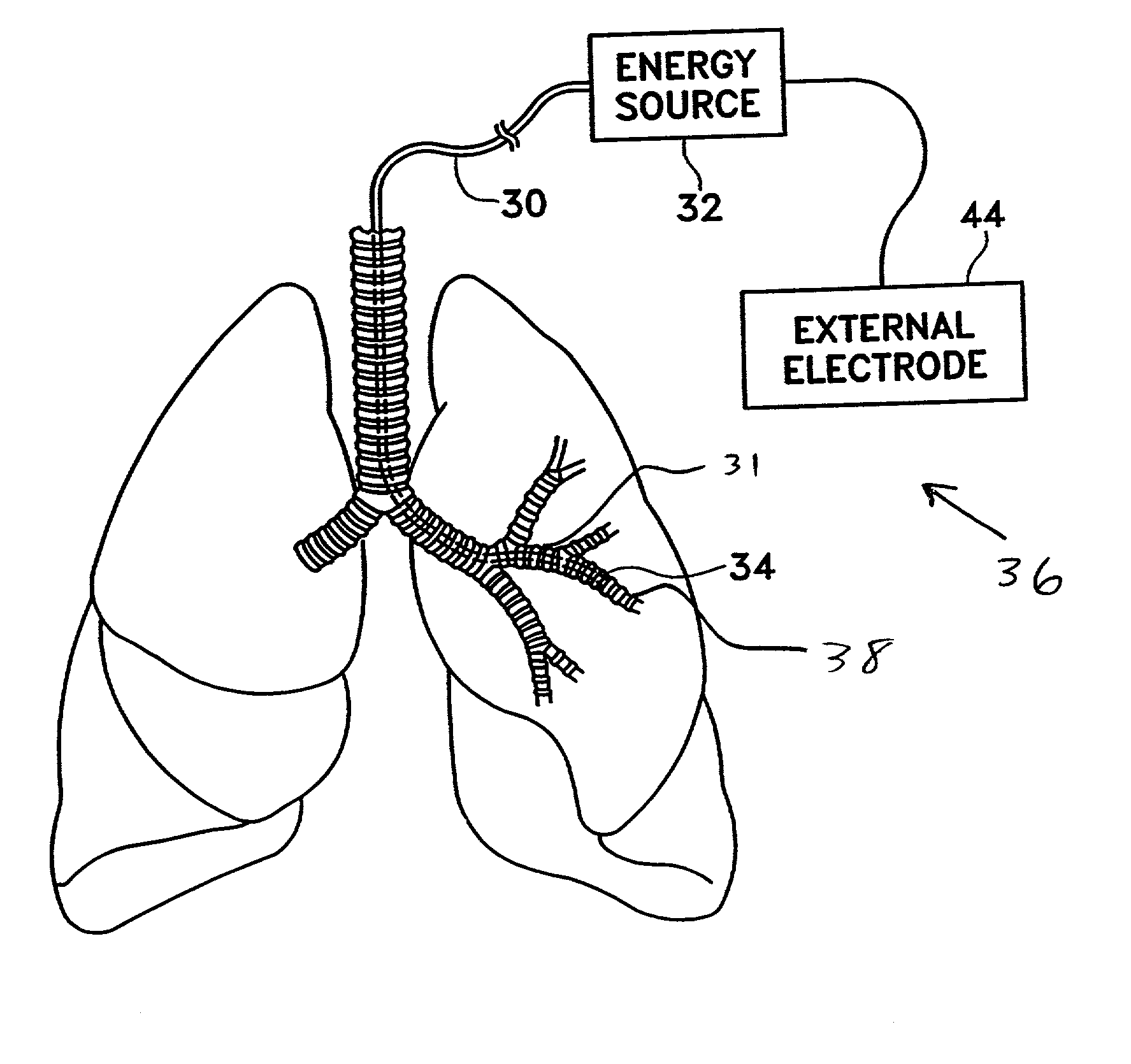 Method for treating an asthma attack