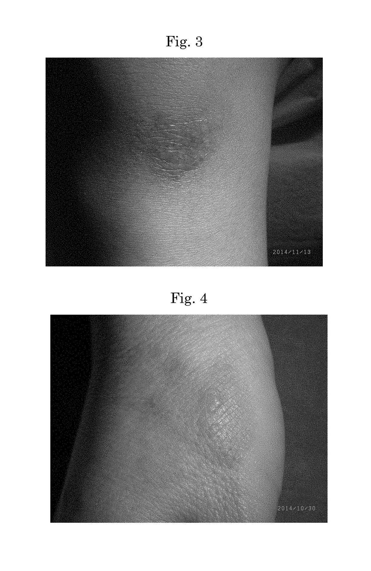 Method for coating skin abrasion, laceration, burn or oedema after surgery