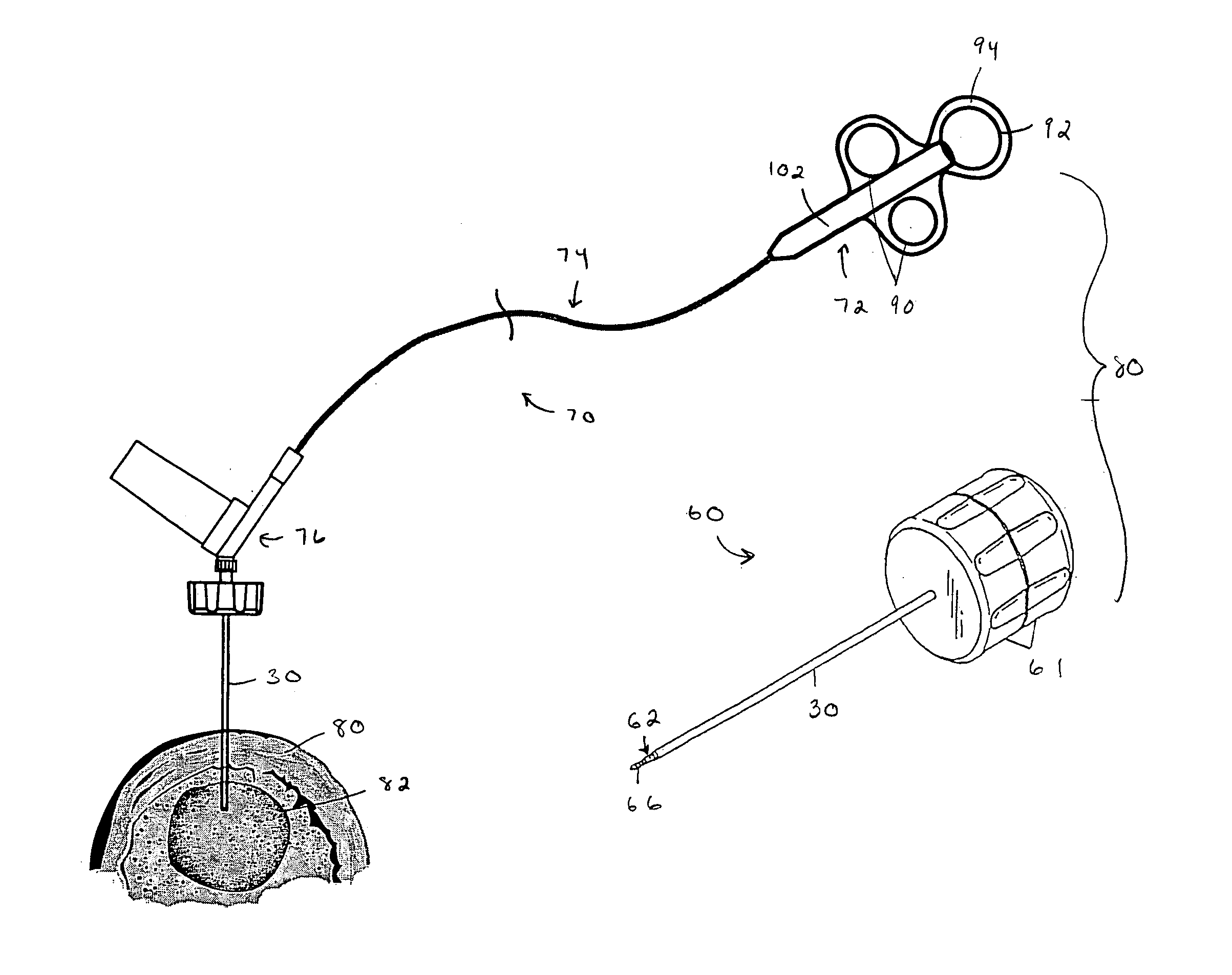 Remotely actuated system for bone cement delivery