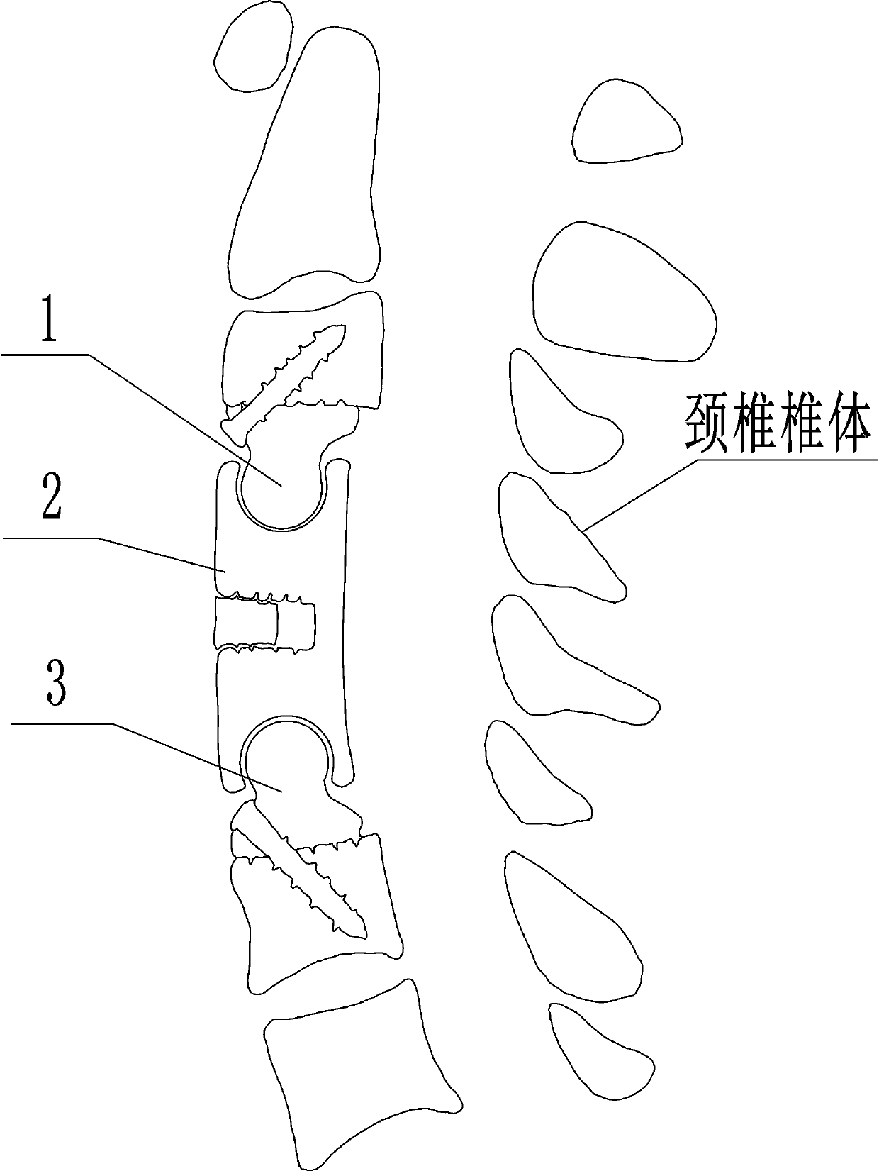 Anterior zero-incisura fixed combined type movable artificial cervical vertebra body and using method