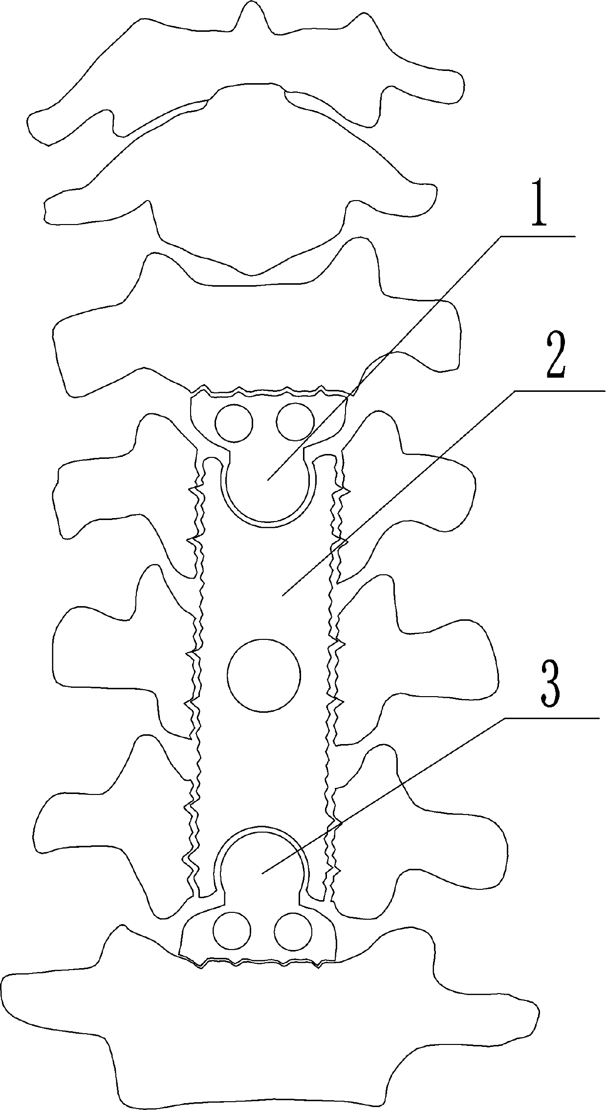 Anterior zero-incisura fixed combined type movable artificial cervical vertebra body and using method