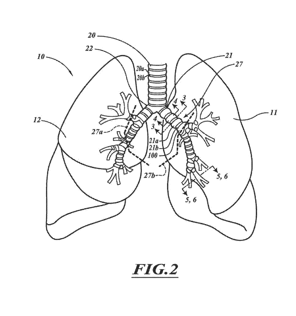Compact delivery pulmonary treatment systems and methods for improving pulmonary function