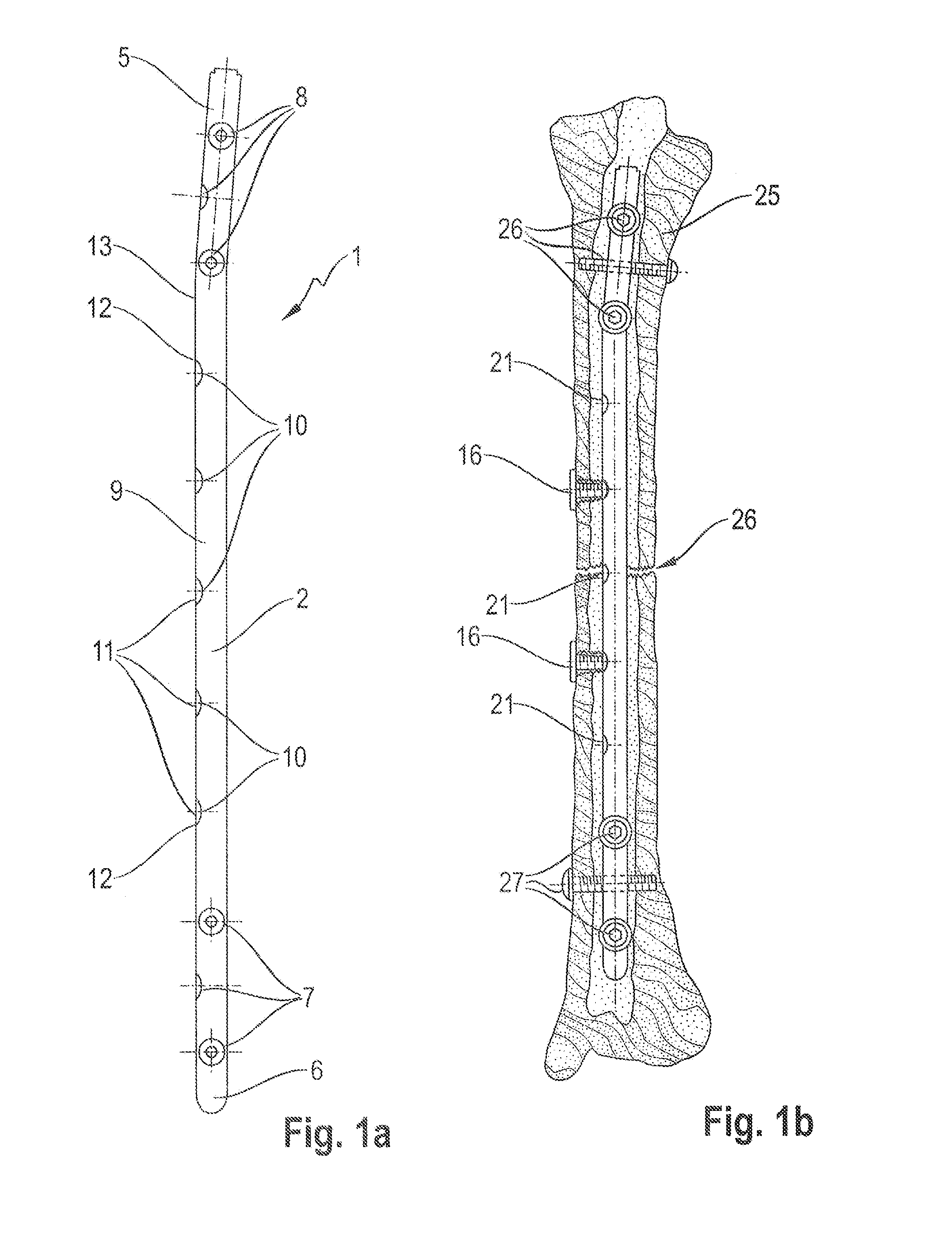 Osteosynthesis system for the multidirectional, angular-stable treatment of fractures of tubular bones comprising an intramedullary nail and bone screws