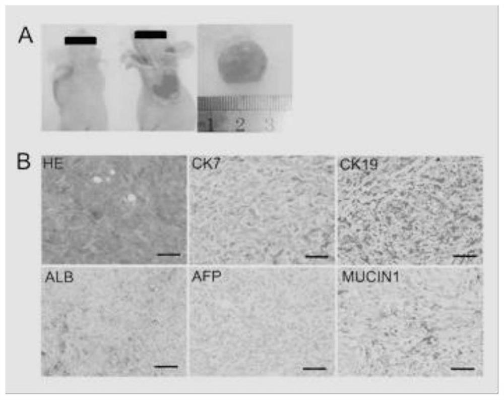 A method for inducing transformation of adult liver stem cells into highly metastatic liver cancer cells and corresponding cells