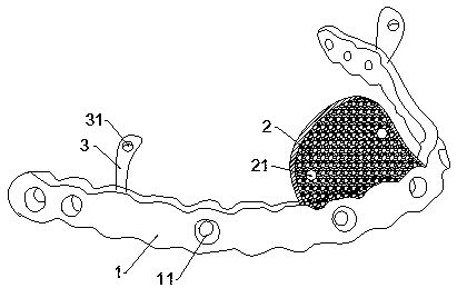 Mandible reduction device