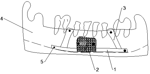Mandible reduction device