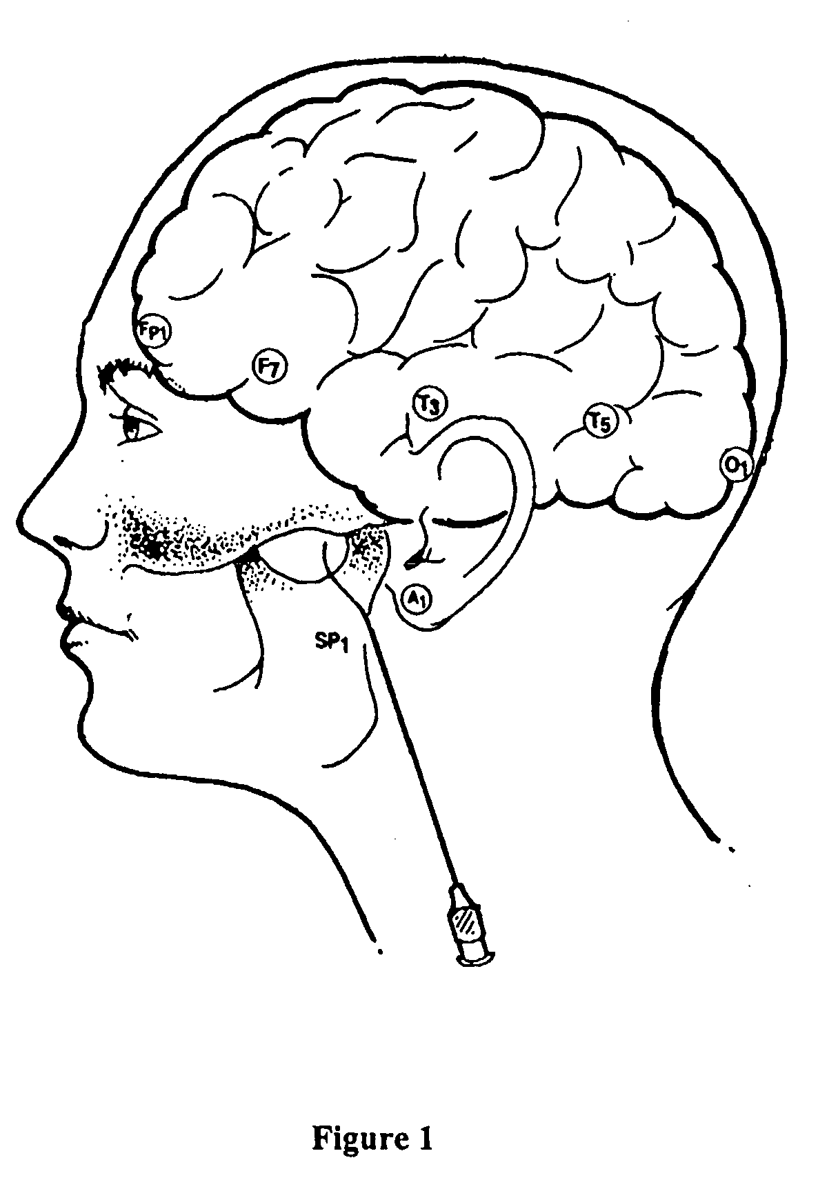 Noninvasive nonlinear systems and methods for predicting seizure