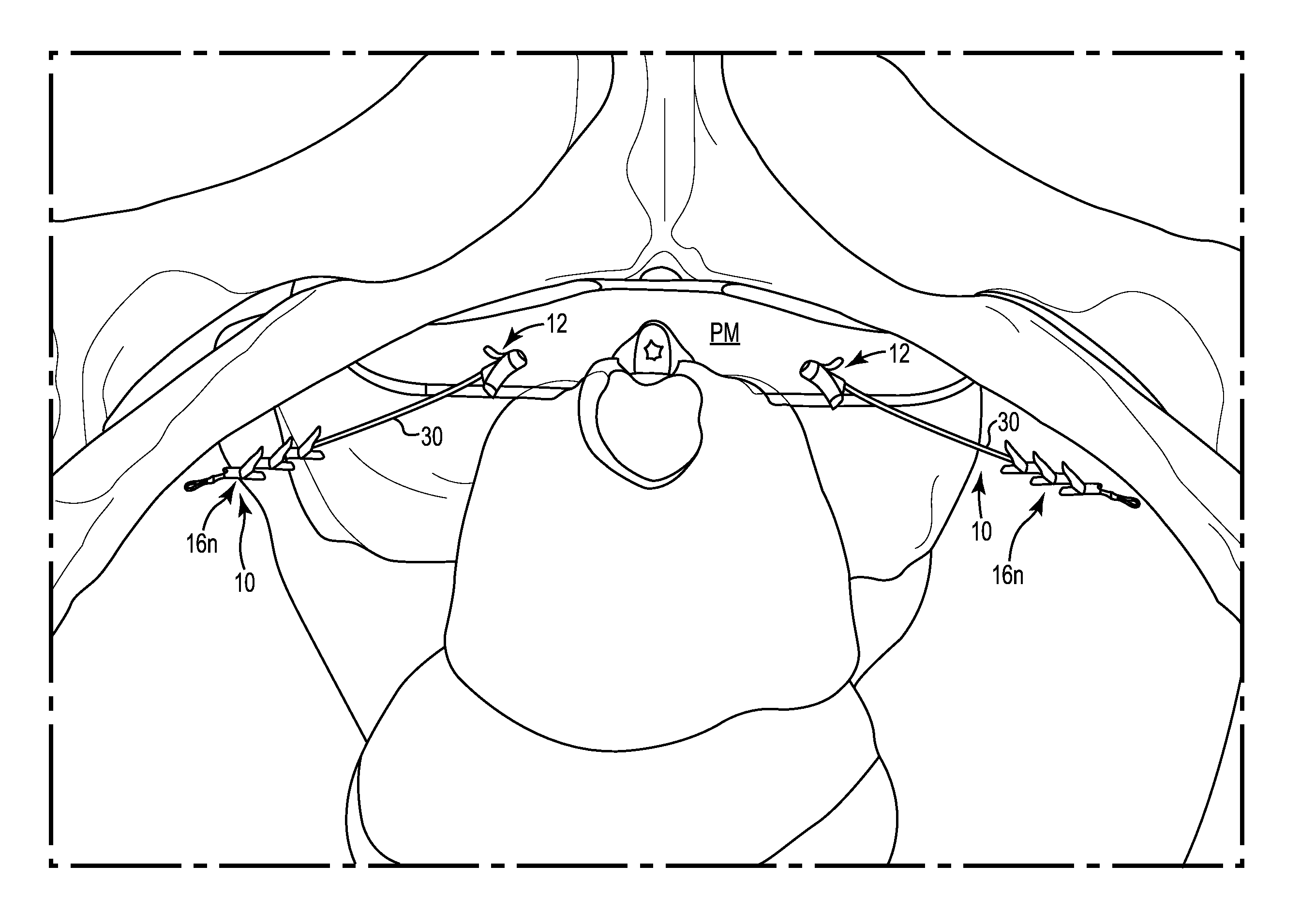 Pelvic implant system and method