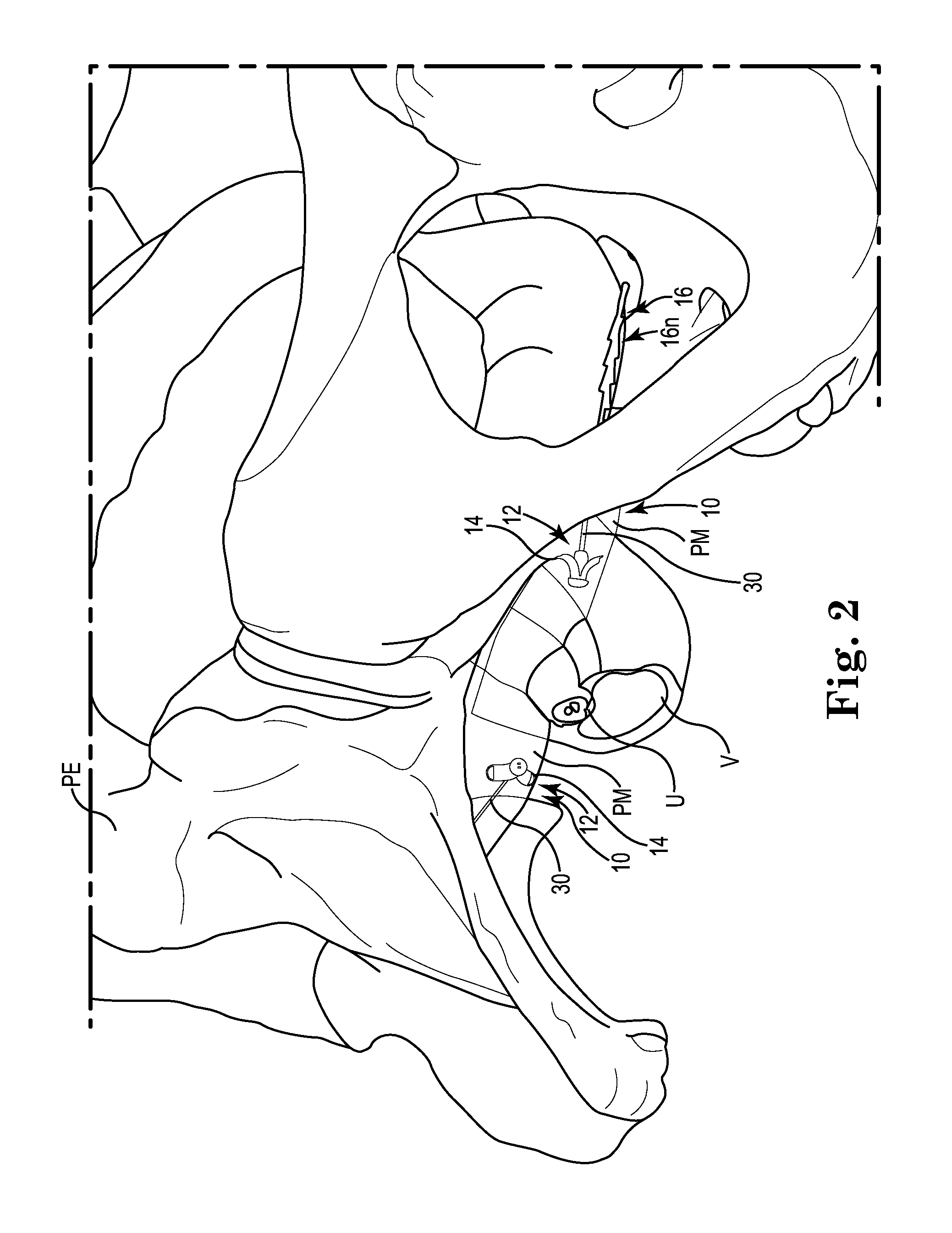 Pelvic implant system and method