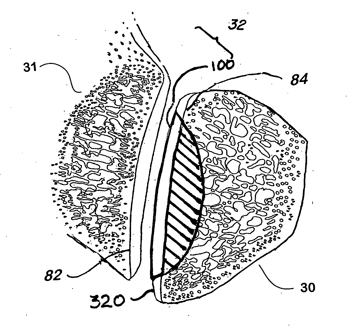 Devices and methods for treating facet joints