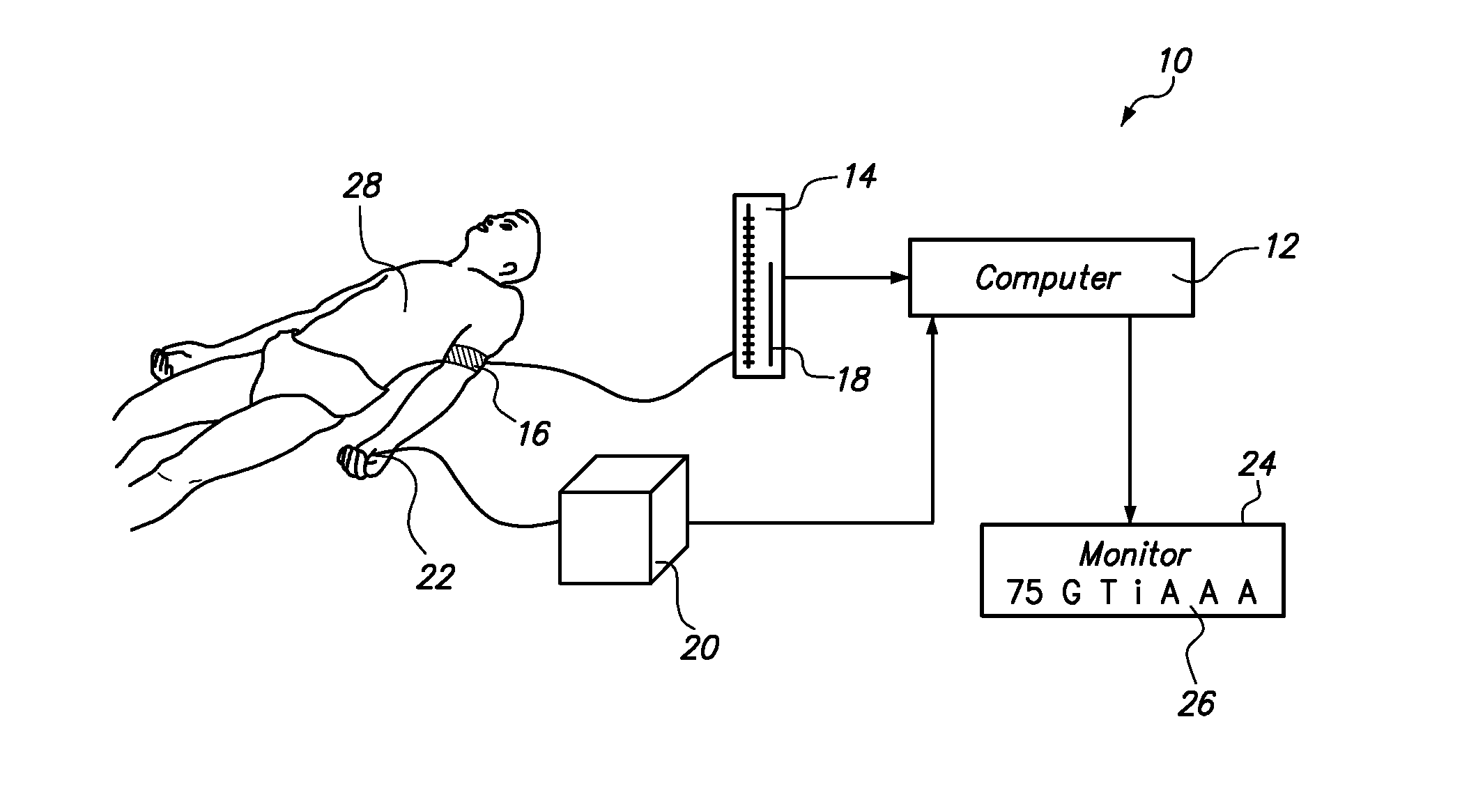 Method for Using a Pulse Oximetry Signal to Monitor Blood Pressure