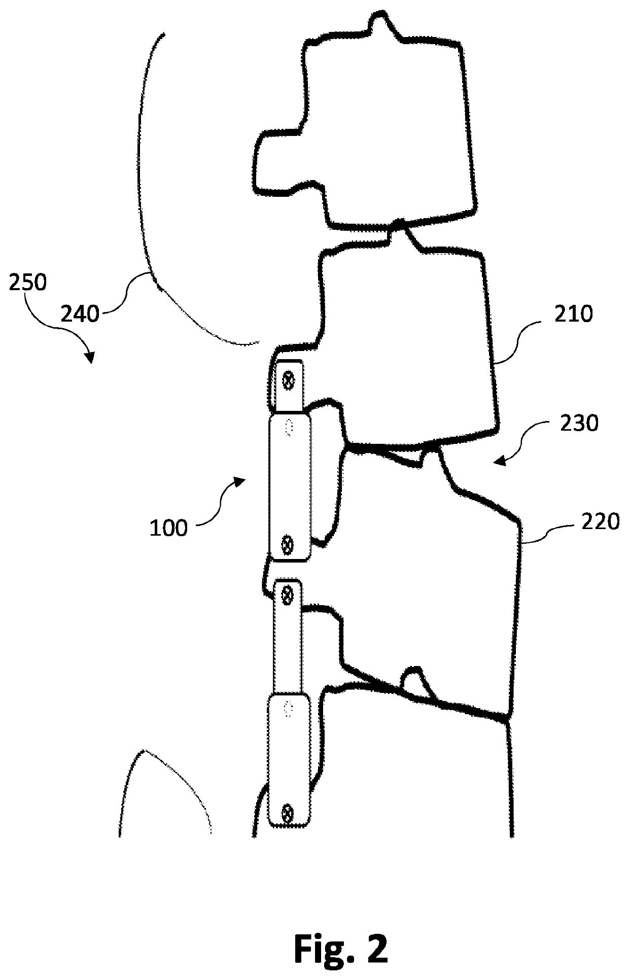 Non-invasively adjustable spinal stabilization device