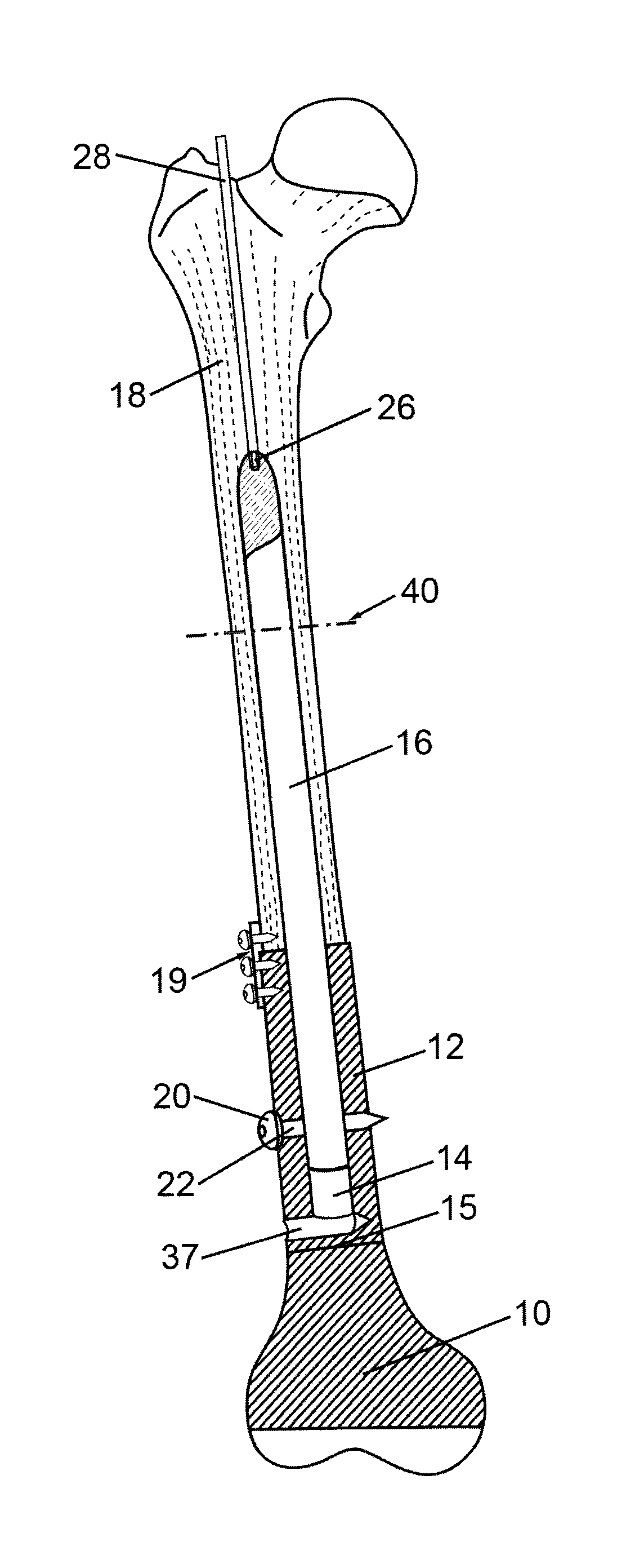 Implantable prosthesis for replacing a human hip or knee joint and the adjoining bone sections