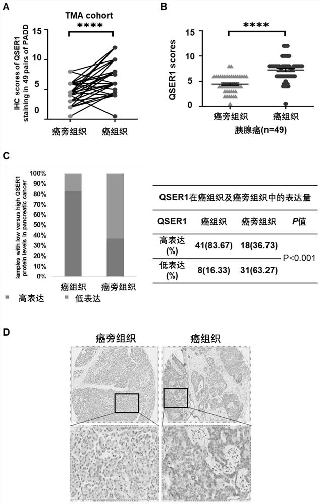 Application of QSER1 gene and related medicine thereof