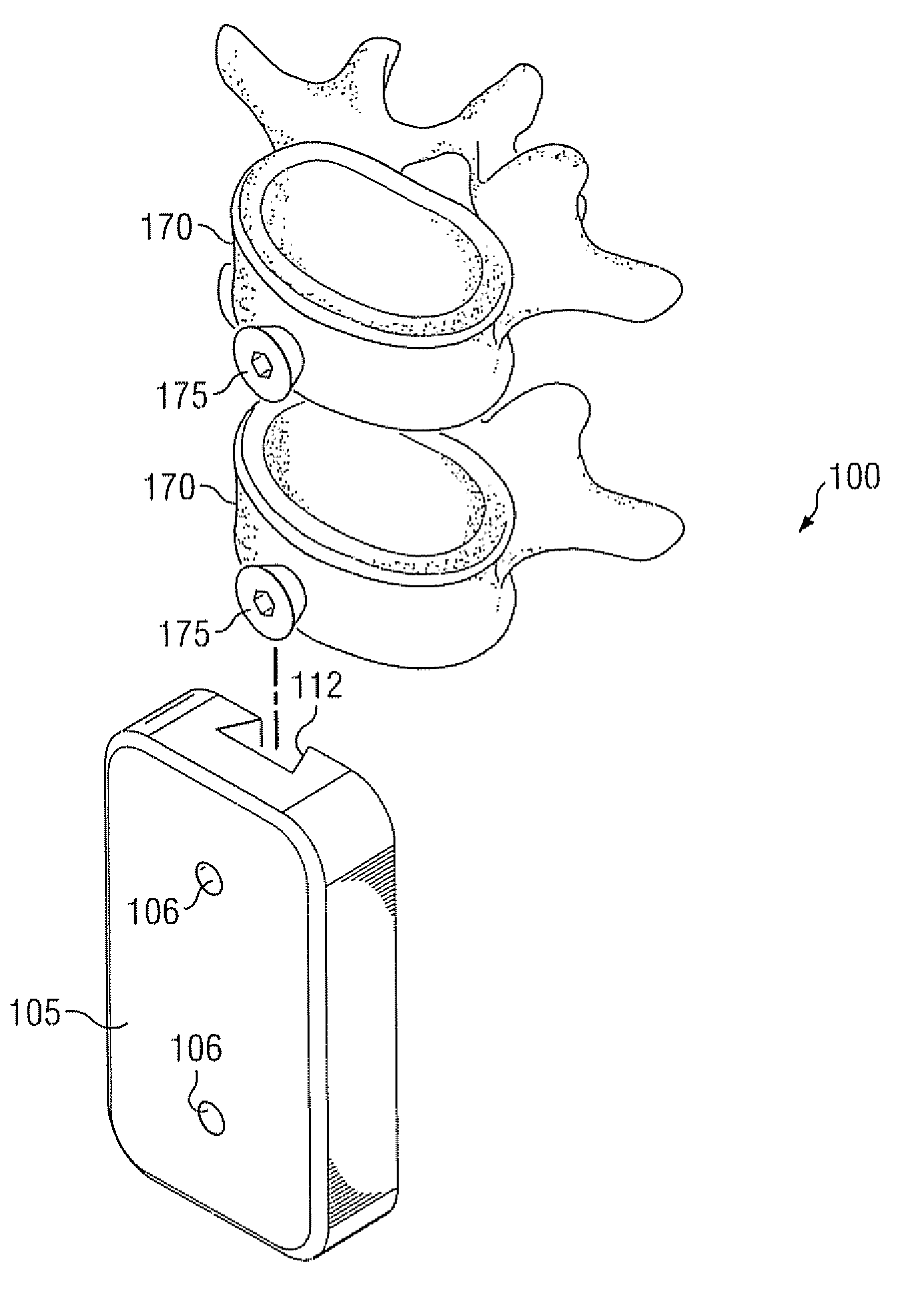 Device and system for stabilizing movement between bony tissue and method for implanting