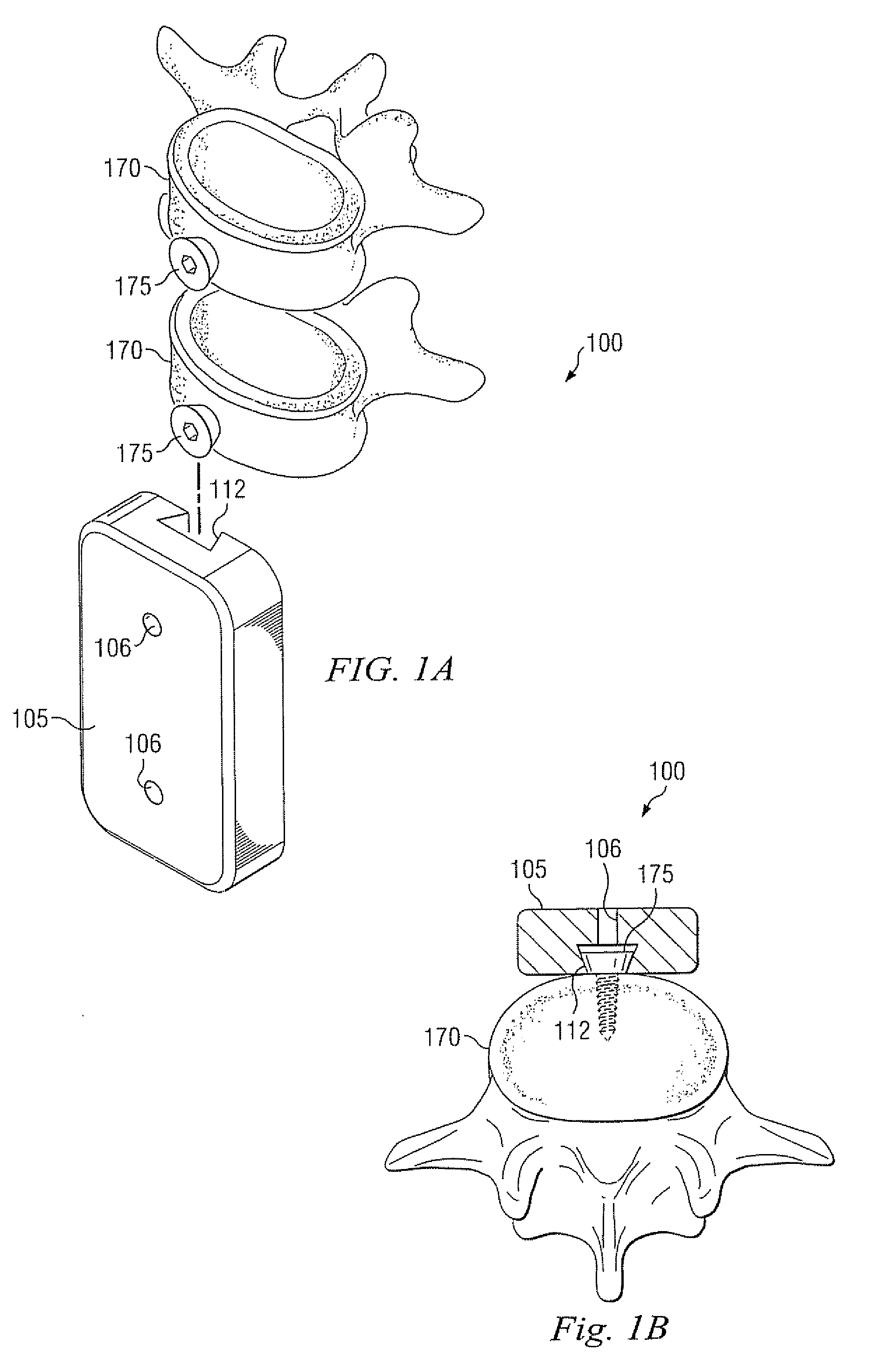 Device and system for stabilizing movement between bony tissue and method for implanting