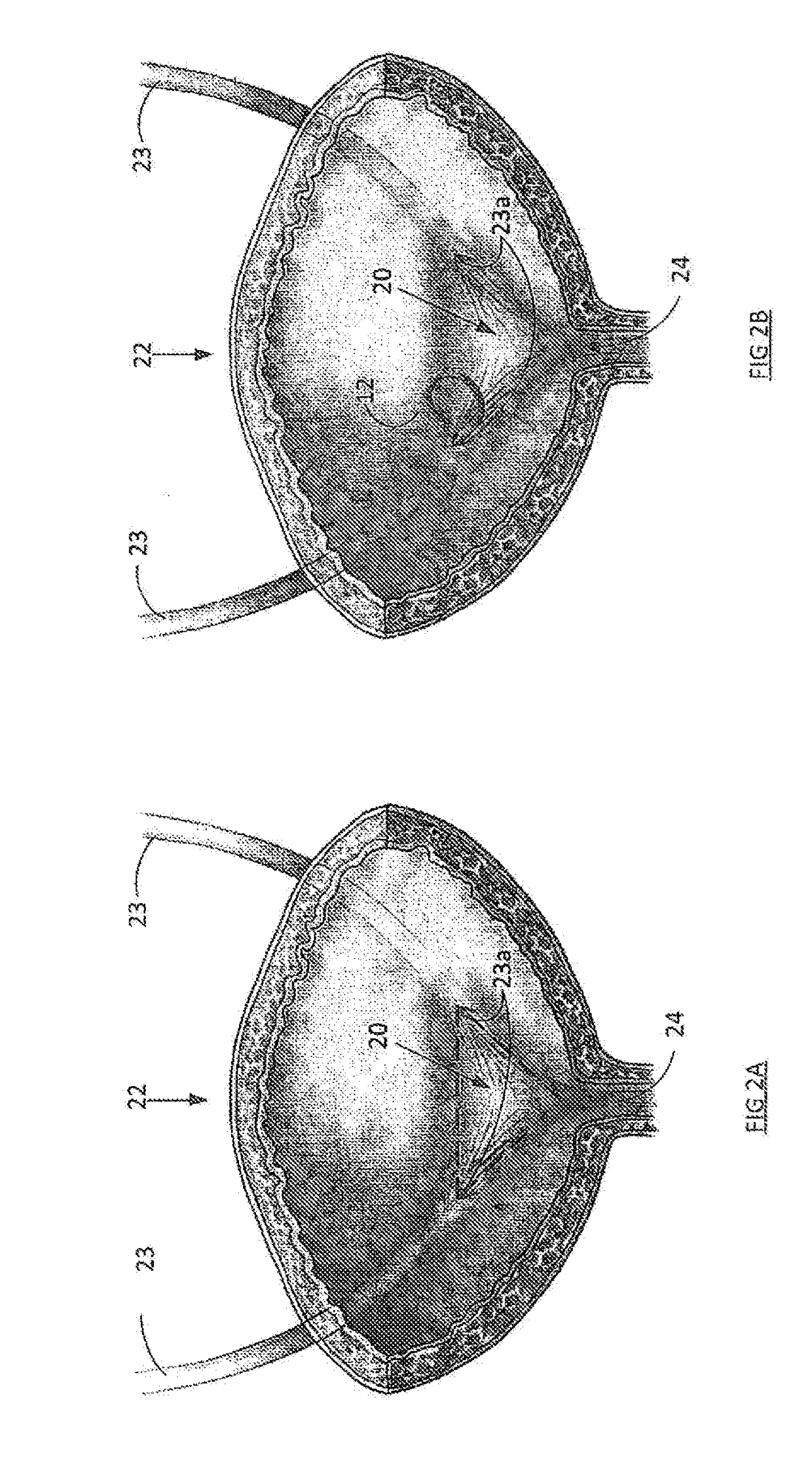 Stent and Method of Use