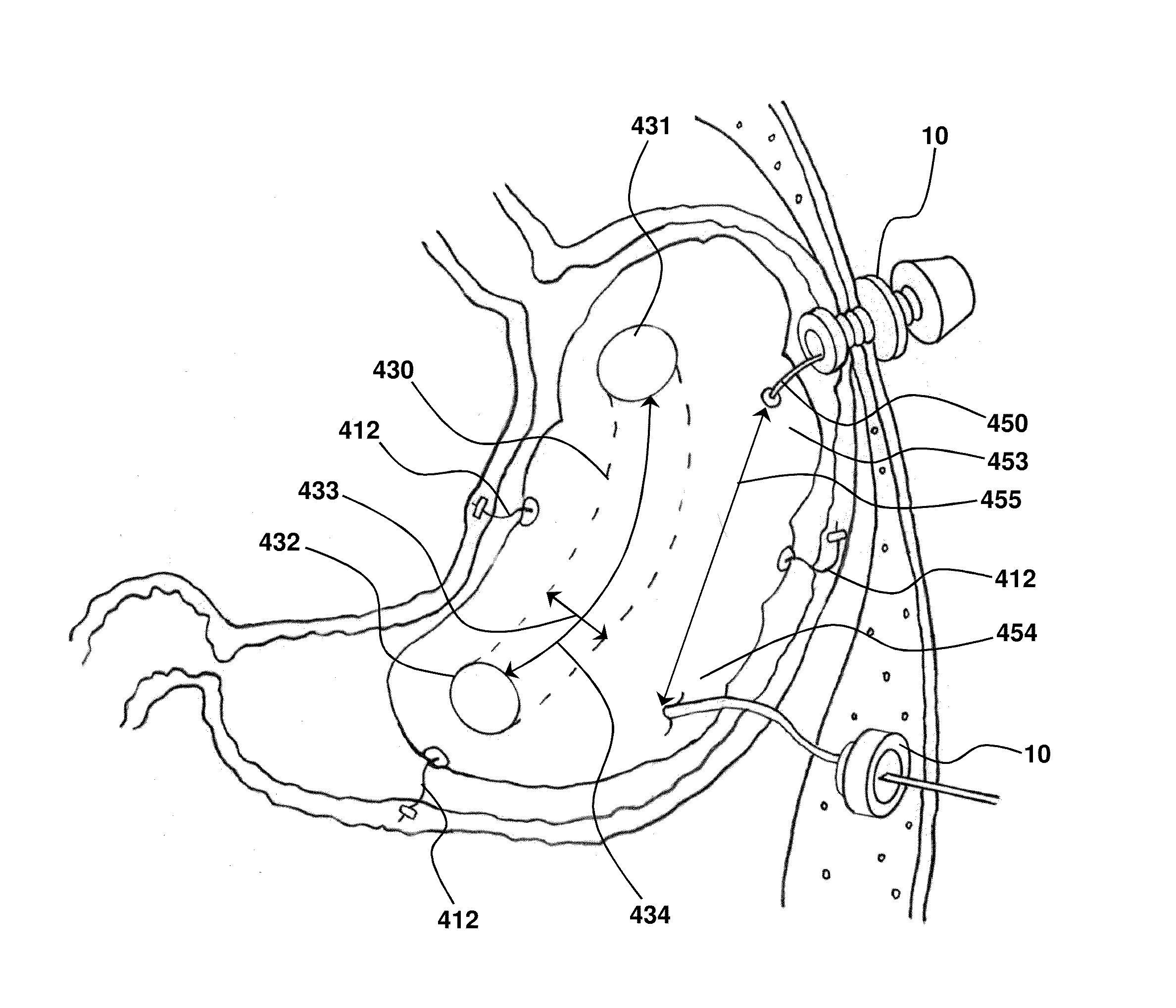 Anchorable size-varying gastric balloons for weight loss