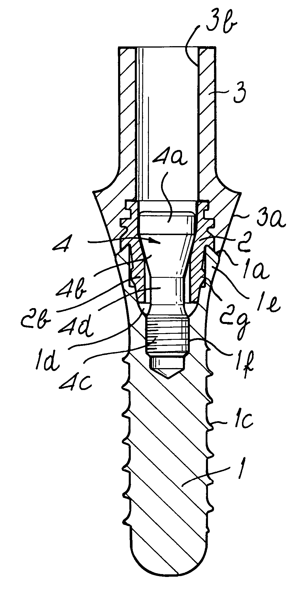 Dental implant system