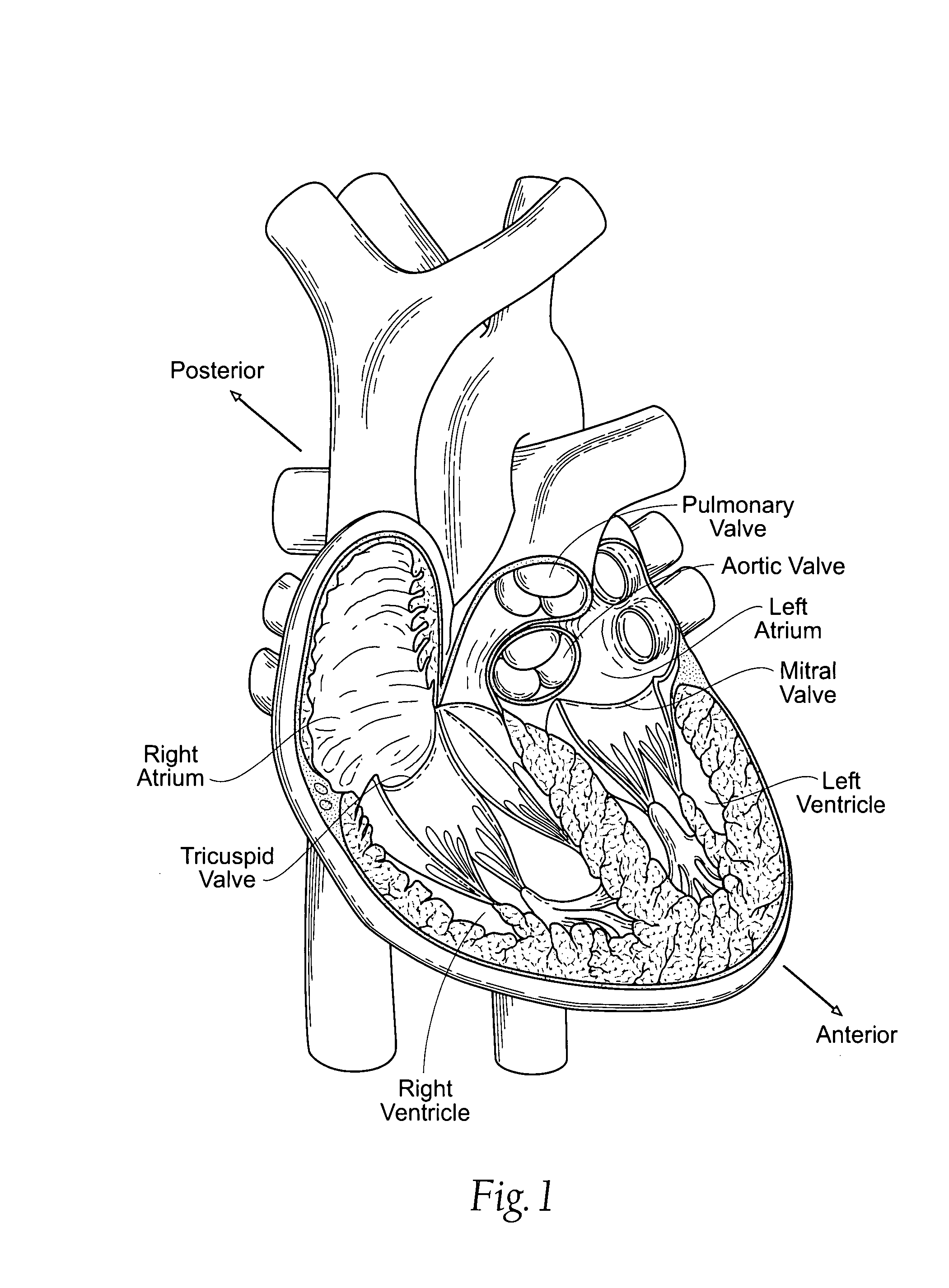Devices, systems, and methods for reshaping a heart valve annulus, including the use of a bridge implant having an adjustable bridge stop