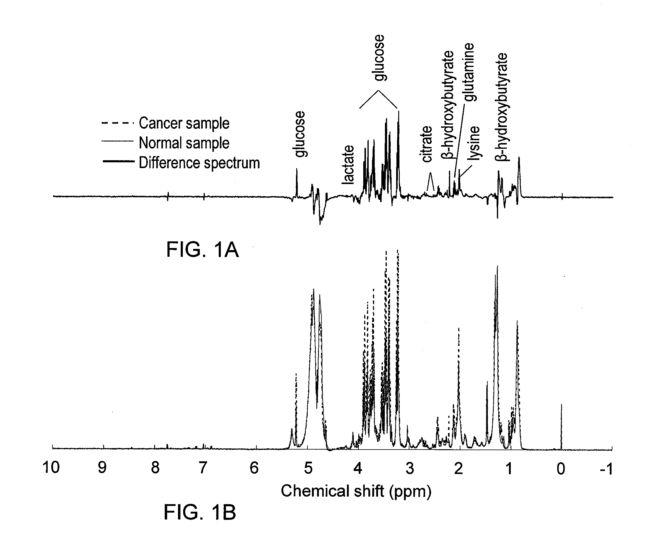 Metabolite Biomarkers for the Detection of Esophageal Cancer Using NMR