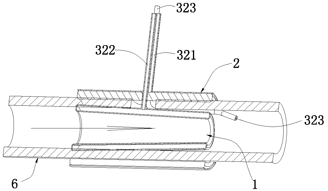 Intestinal fistula stent kit