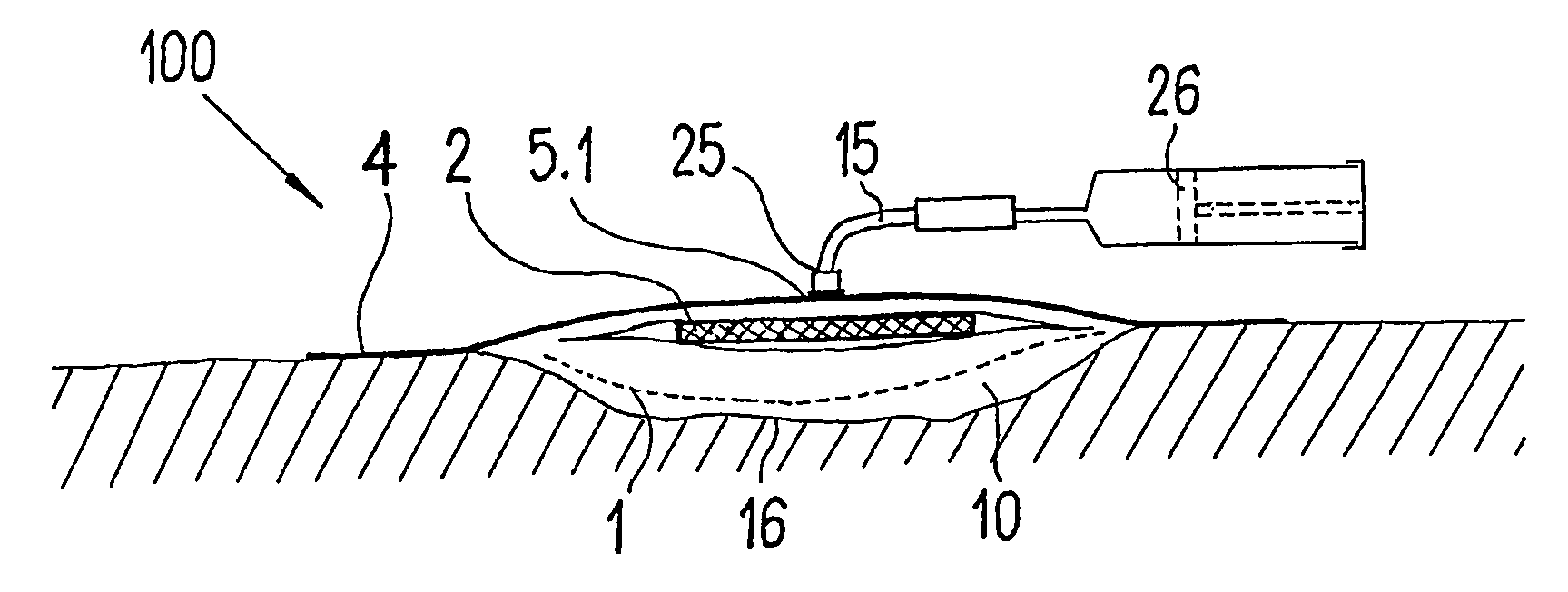 Device for the Treatment of Wounds Using a Vacuum