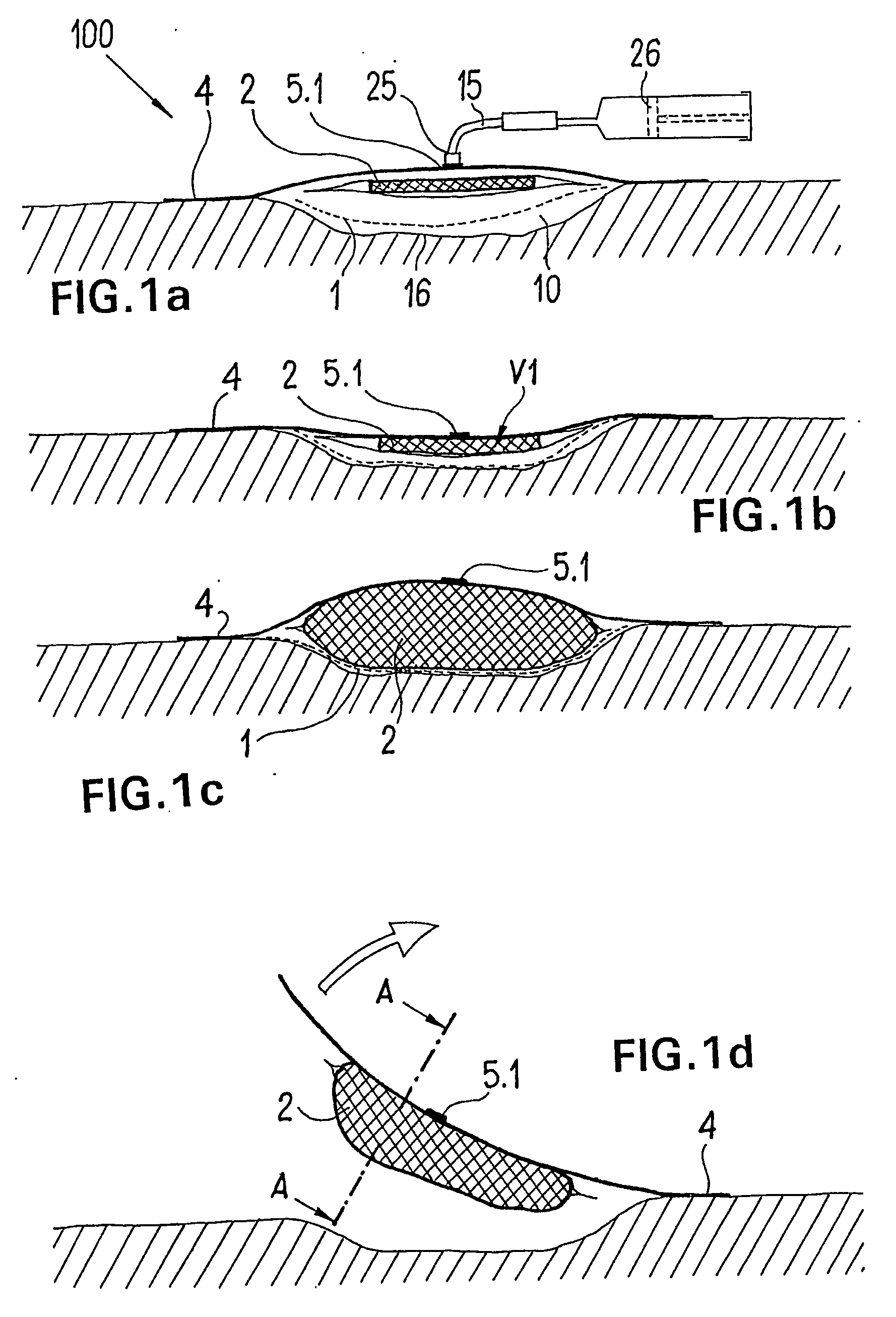 Device for the Treatment of Wounds Using a Vacuum