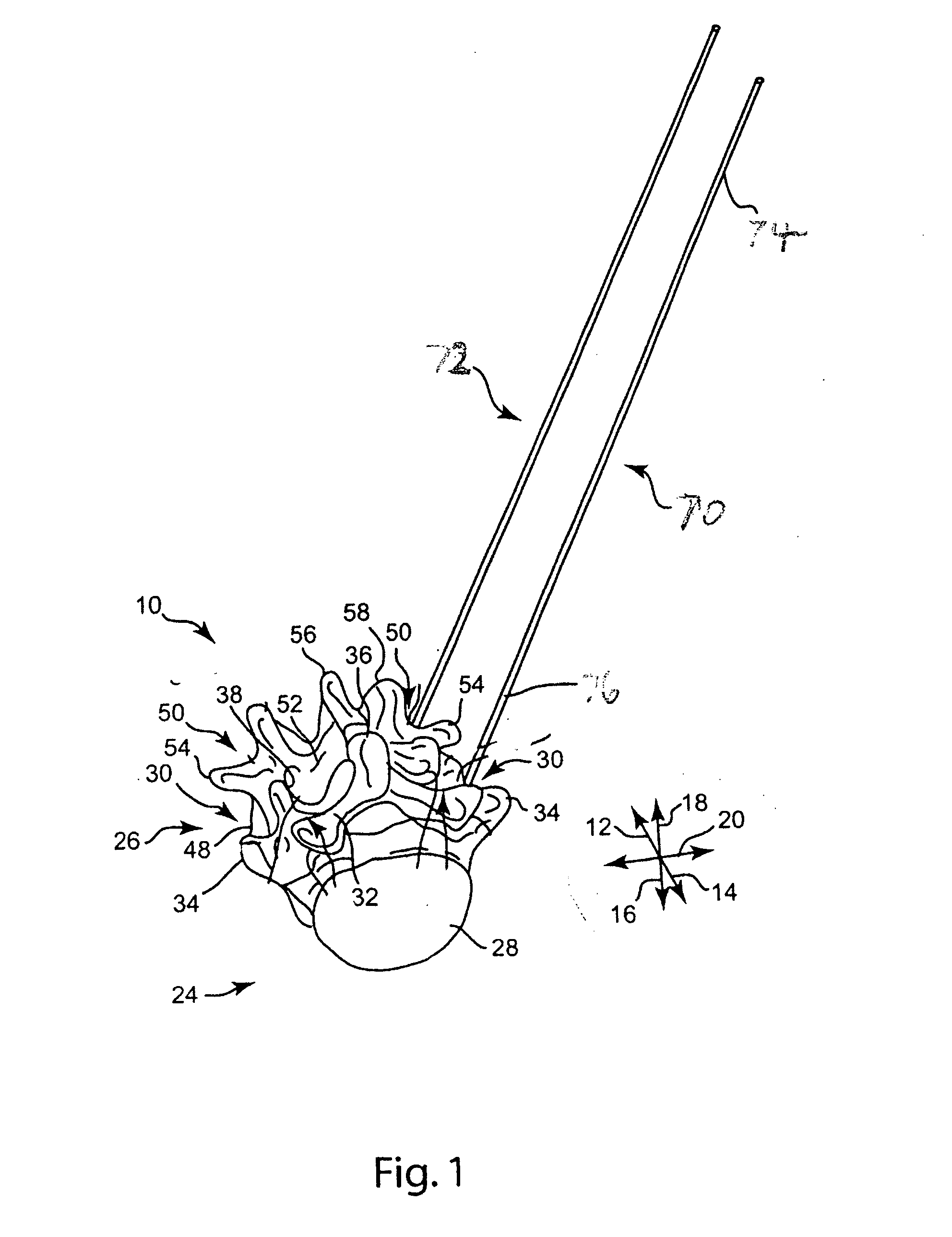 Rod contouring apparatus and method for percutaneous pedicle screw extension