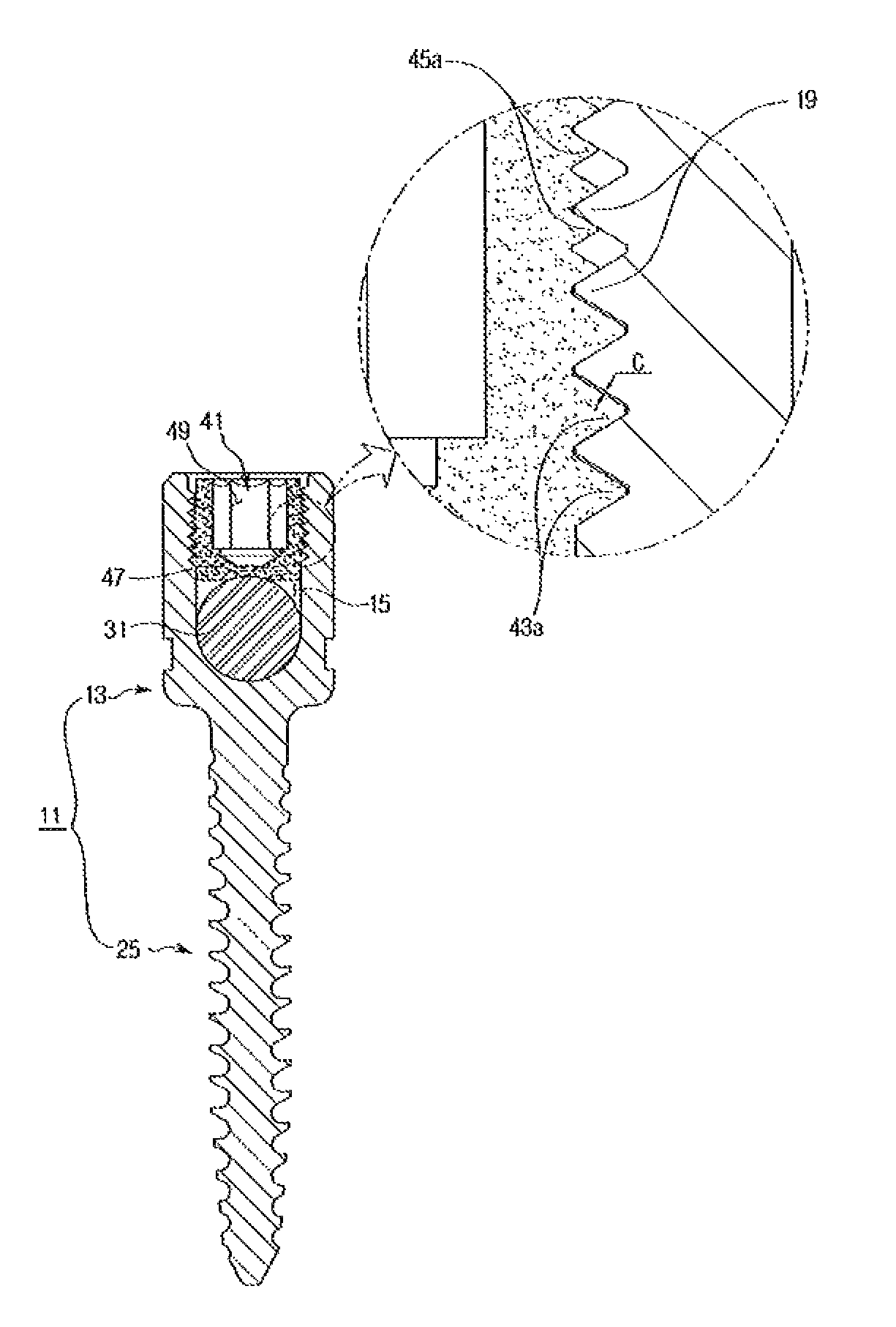 Spine fixation device containing set screw having double spiral form