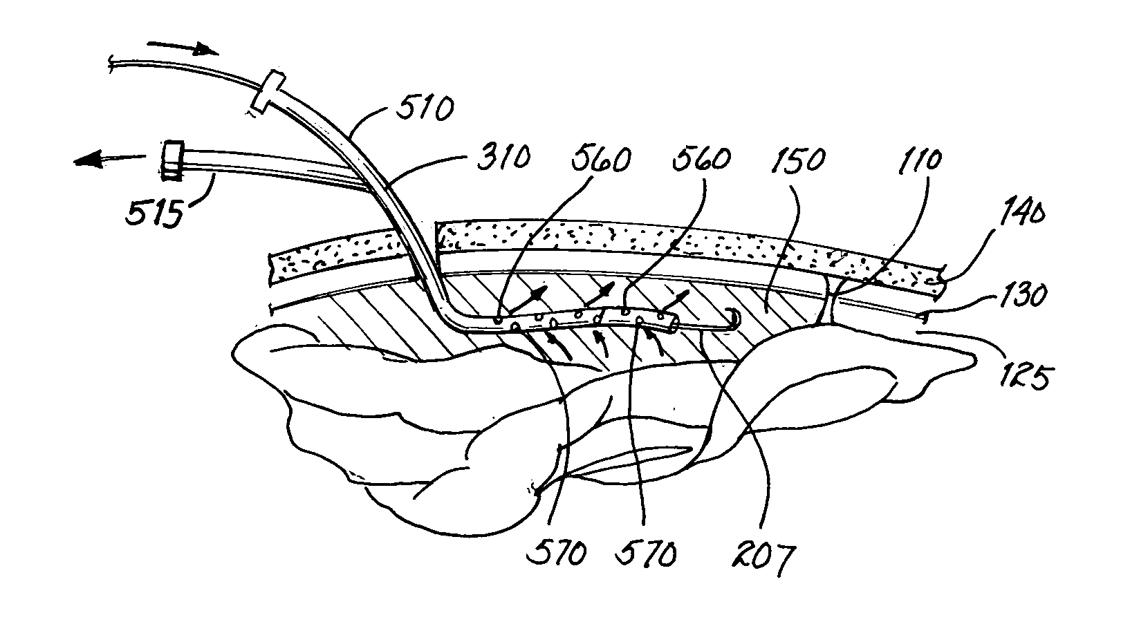 Method and apparatus for irrigation and drainage of the brain's subdural space using a percutaneous approach