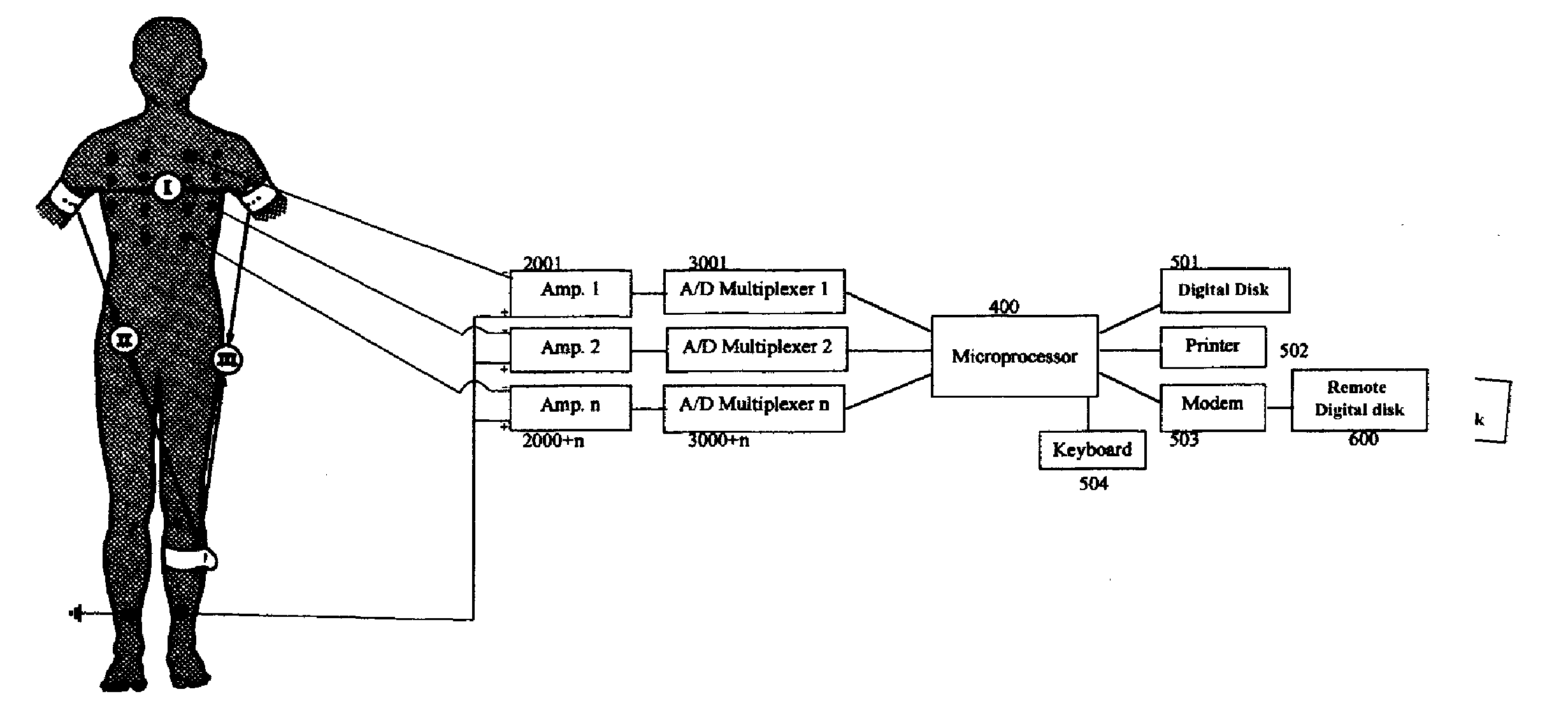 Bipolar, Non-Vectorial Electrocardiography