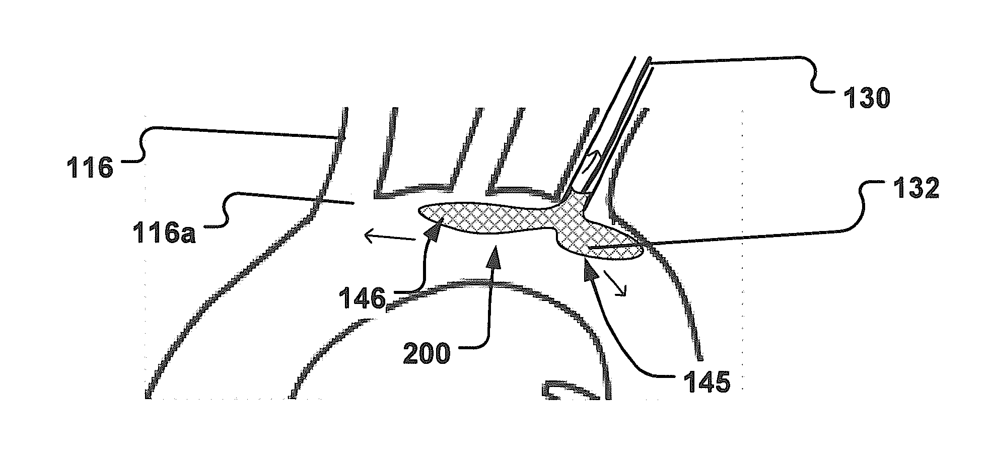 Temporary Embolic Protection Device And Medical Procedure For Delivery Thereof