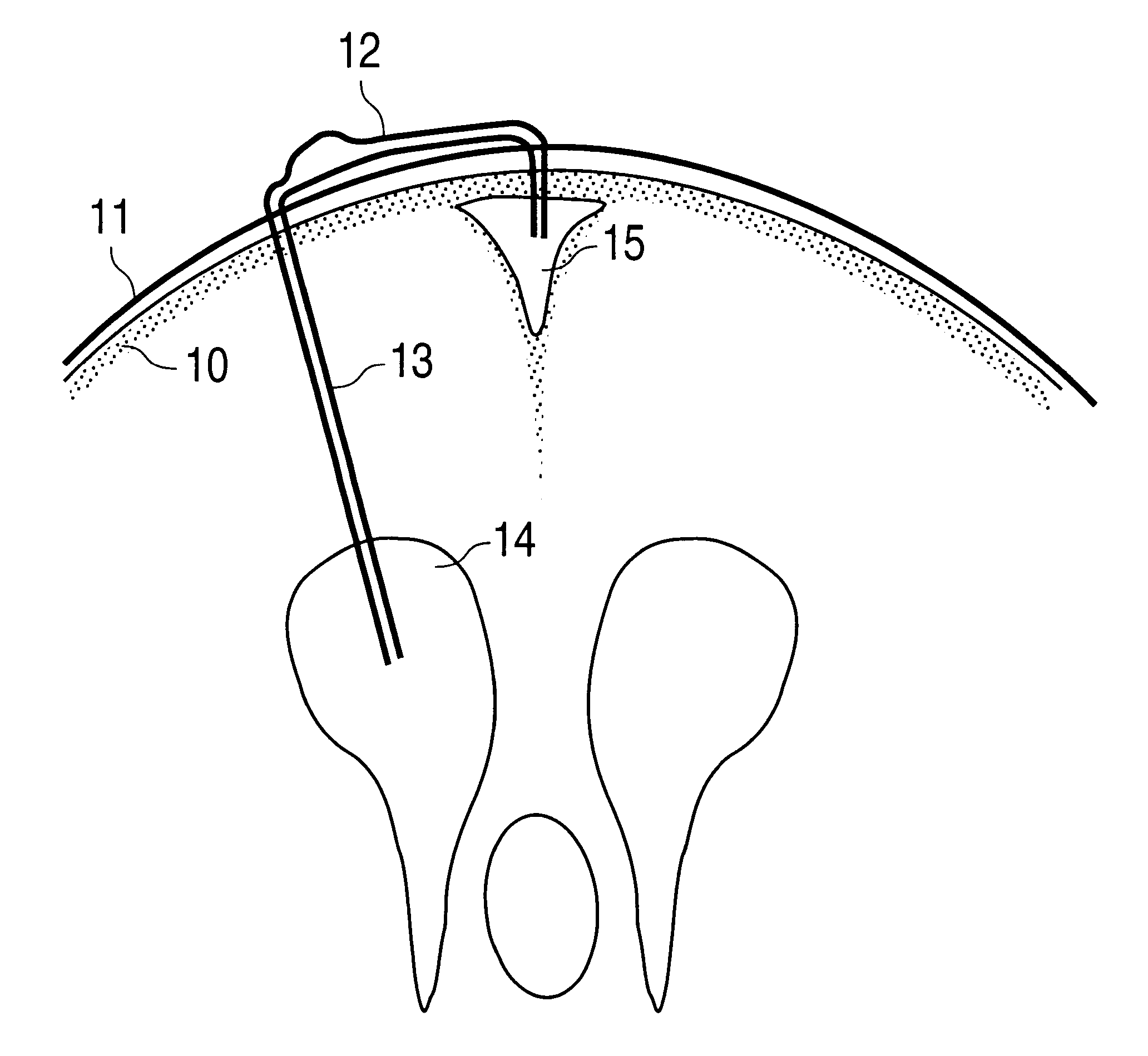 Device for the treatment of hydrocephalus