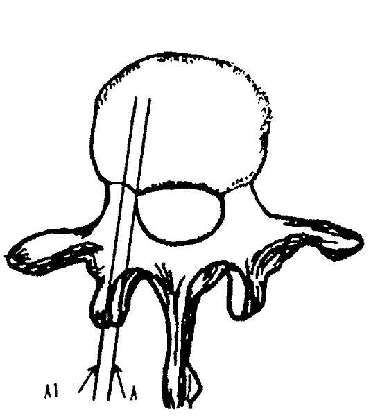 X-ray-film-based method for locating coordinates of pedicle screws