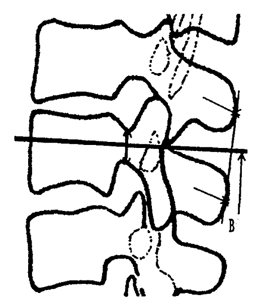 X-ray-film-based method for locating coordinates of pedicle screws