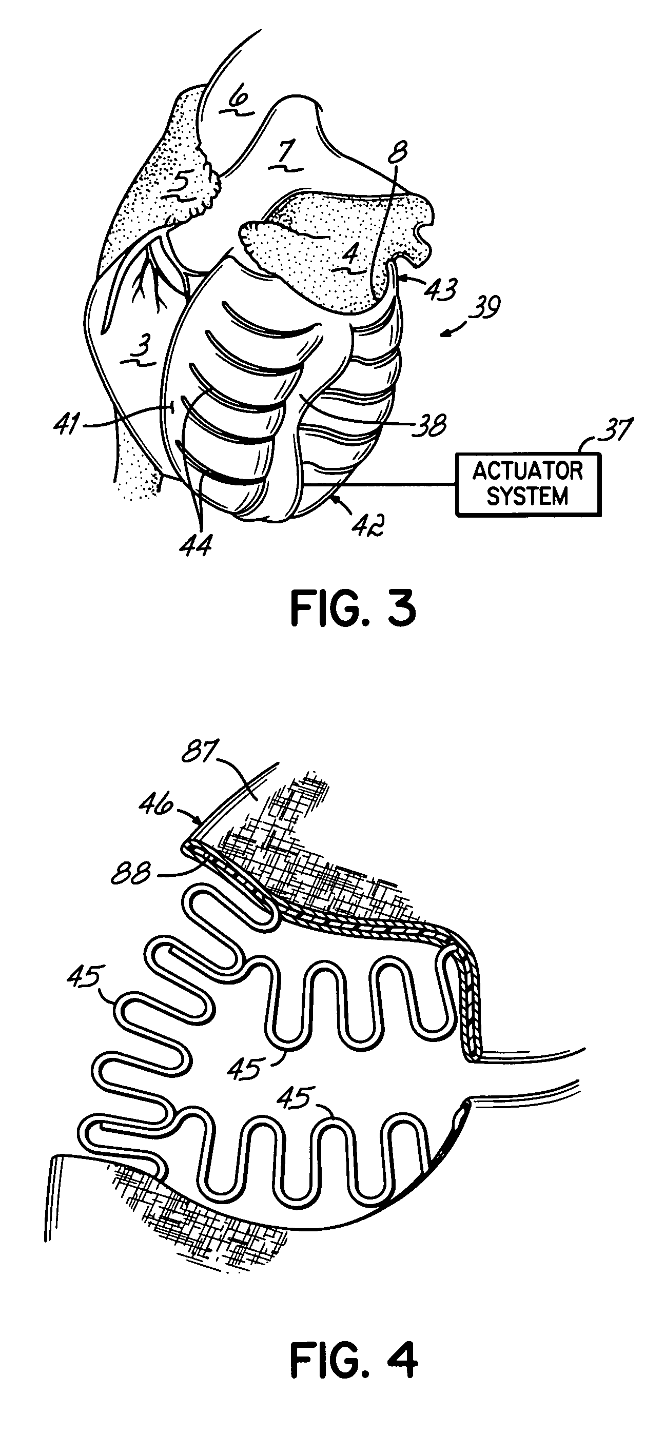 Deforming jacket for a heart actuation device