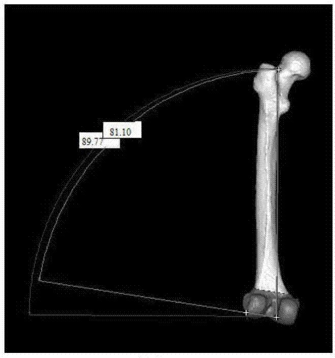 Computer-aided design orthopedics department osteotomy, orthotics and immobilization integrated guide plate and manufacturing method