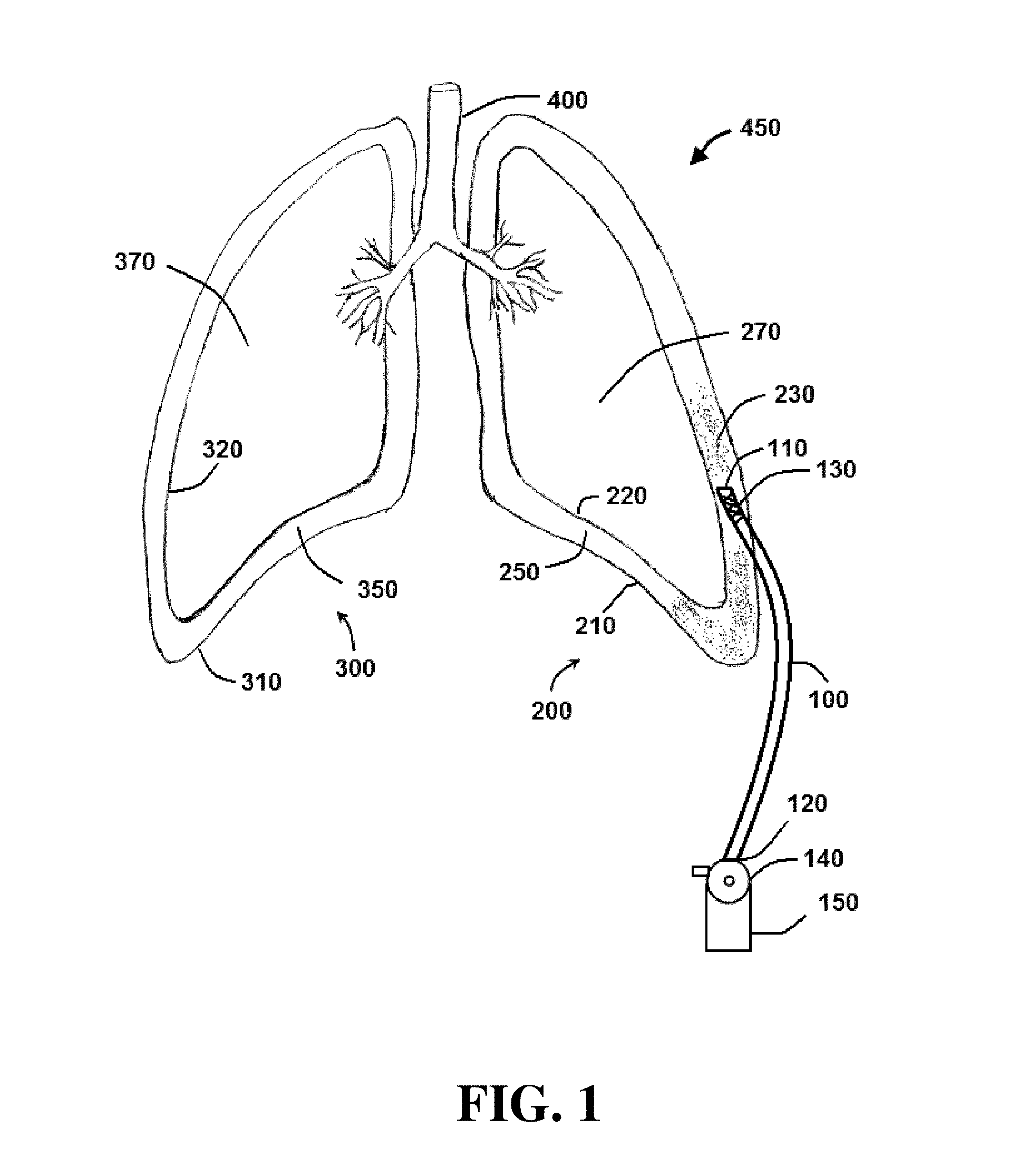 Method and system for sustained-release of sclerosing agent