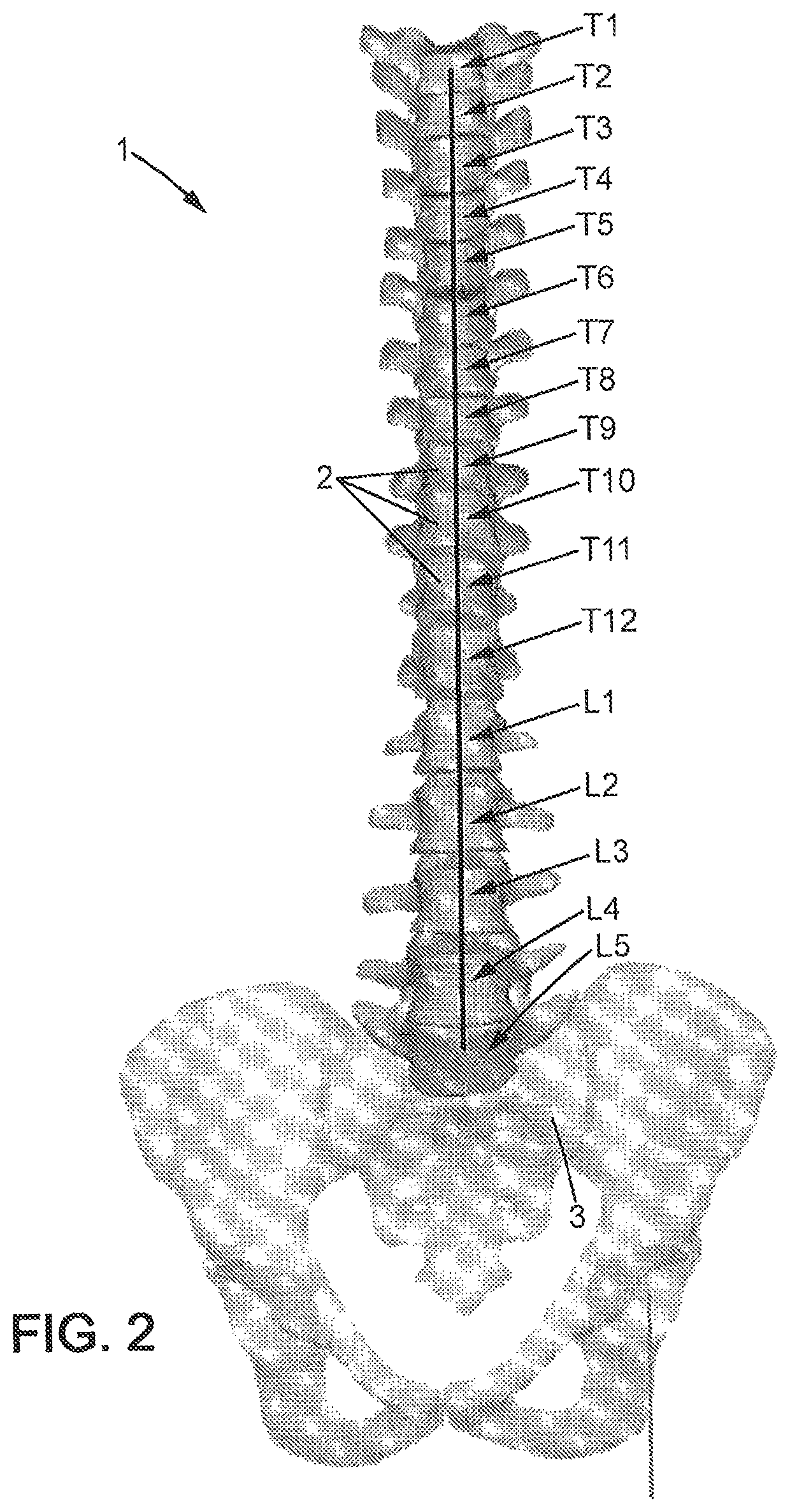 Method of preoperative planning to correct spine misalignment of a patient