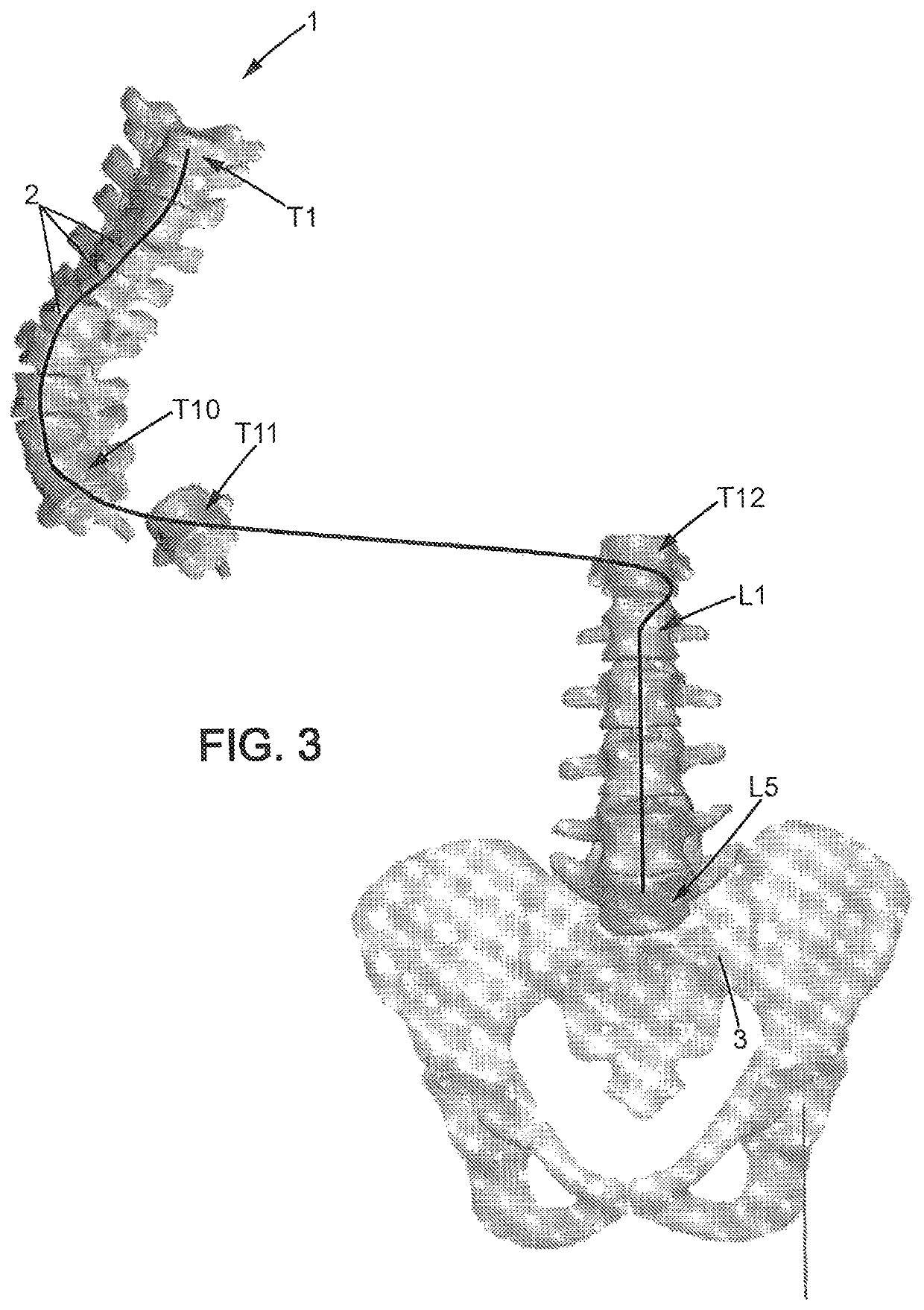 Method of preoperative planning to correct spine misalignment of a patient