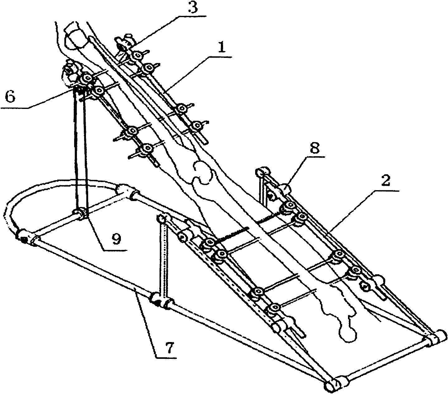 External fixing rack gradually pulling device for treating stiff knee