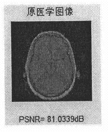 Robust watermarking method for medical image based on Arnold scrambling transformation and DFT (discrete Fourier transformation)